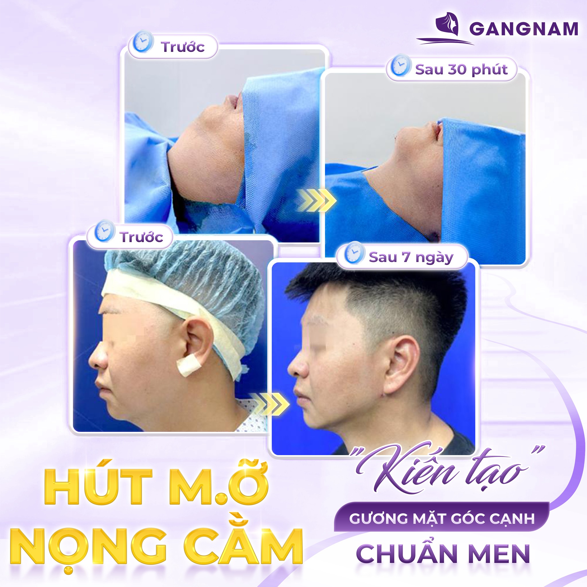 Hút mỡ nọng cằm – Giải pháp định hình đường viền hàm sắc nét 6 Thẩm mỹ Gangnam – Địa chỉ hút mỡ nọng cằm công nghệ cao