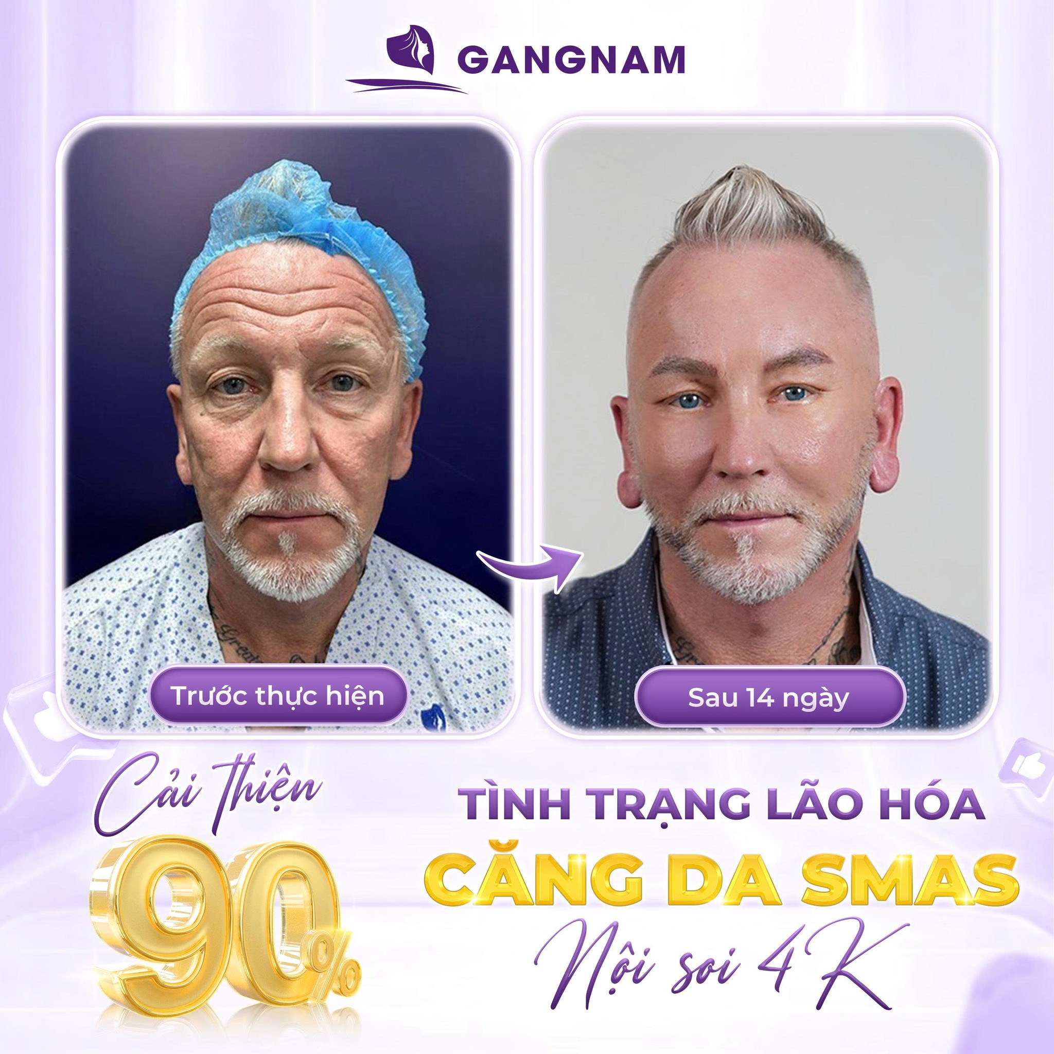 Căng da mặt SMAS toàn phần – Giải pháp trẻ hóa sâu, bền vững 4 Căng da mặt SMAS toàn phần là gì?