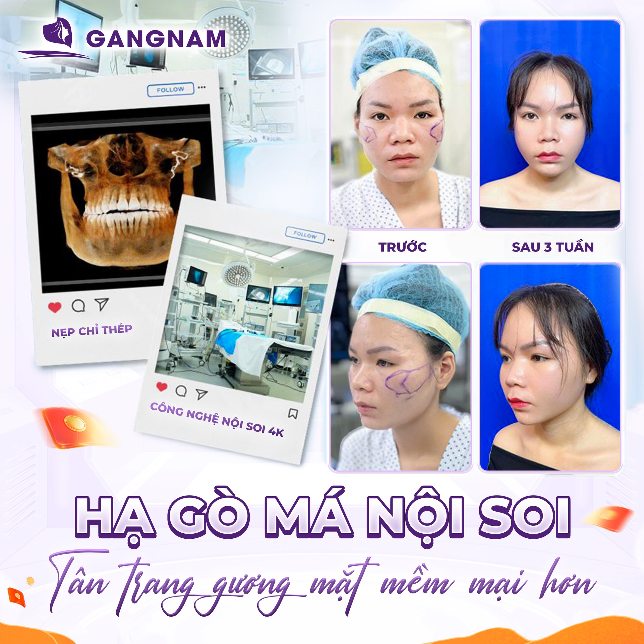 Hạ gò má tạo mặt V-line: Giải pháp thẩm mỹ hiện đại cho gương mặt thanh tú 4 Kỹ thuật hạ gò má L-shape – Phương pháp tiên tiến trong hạ gò má tạo mặt V-line