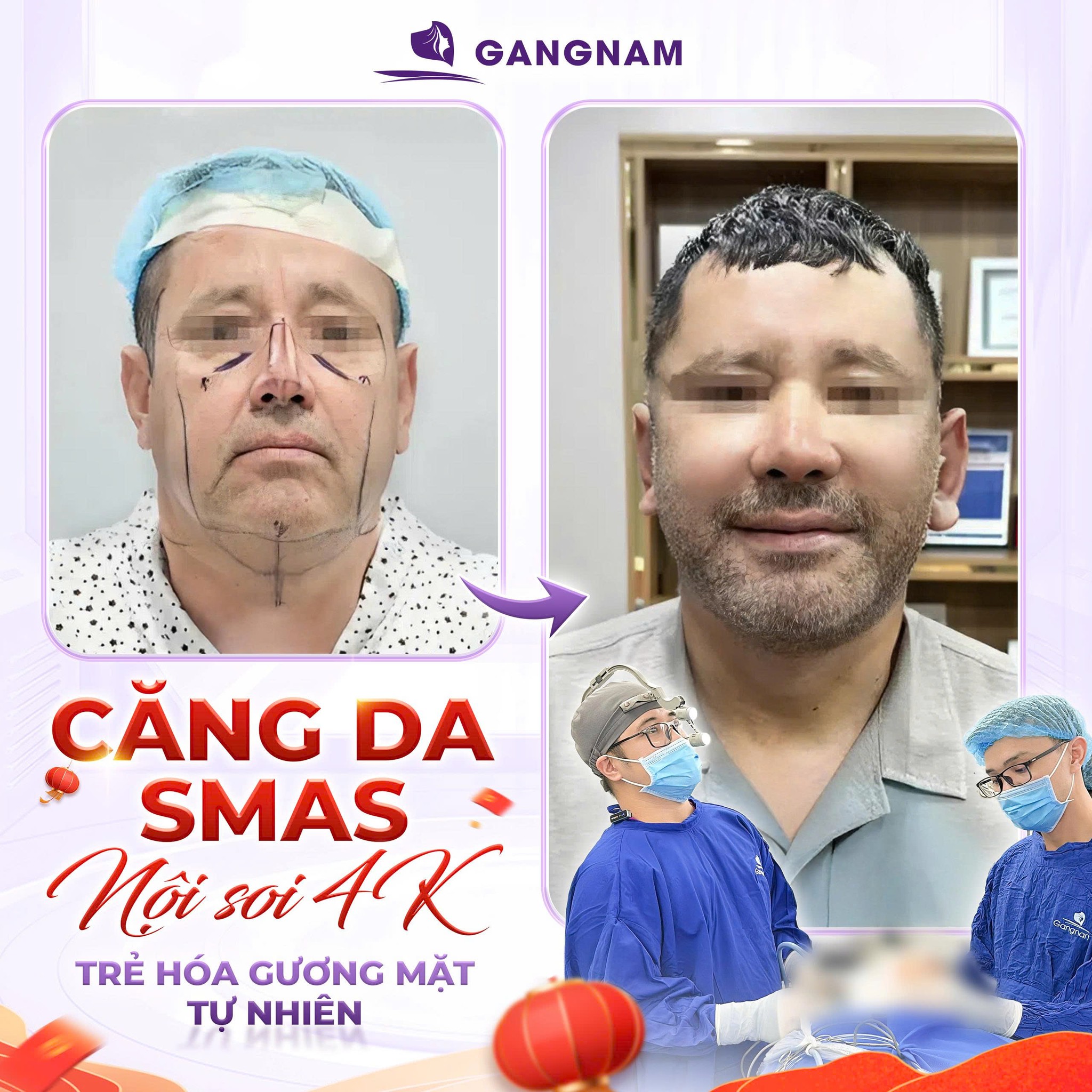 Căng da mặt SMAS toàn phần – Giải pháp trẻ hóa sâu, bền vững 6 Căng da mặt SMAS toàn phần chuẩn y khoa tại Thẩm mỹ Gangnam