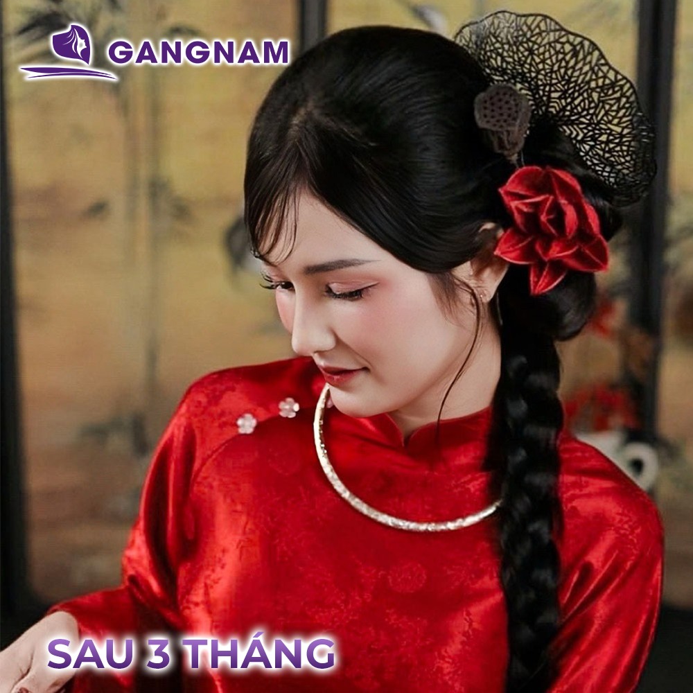 Nâng mũi nội soi Mega Nose – Giải pháp thẩm mỹ mũi an toàn và tự nhiên 4 Nâng mũi nội soi Mega Nose là gì và cơ chế hoạt động