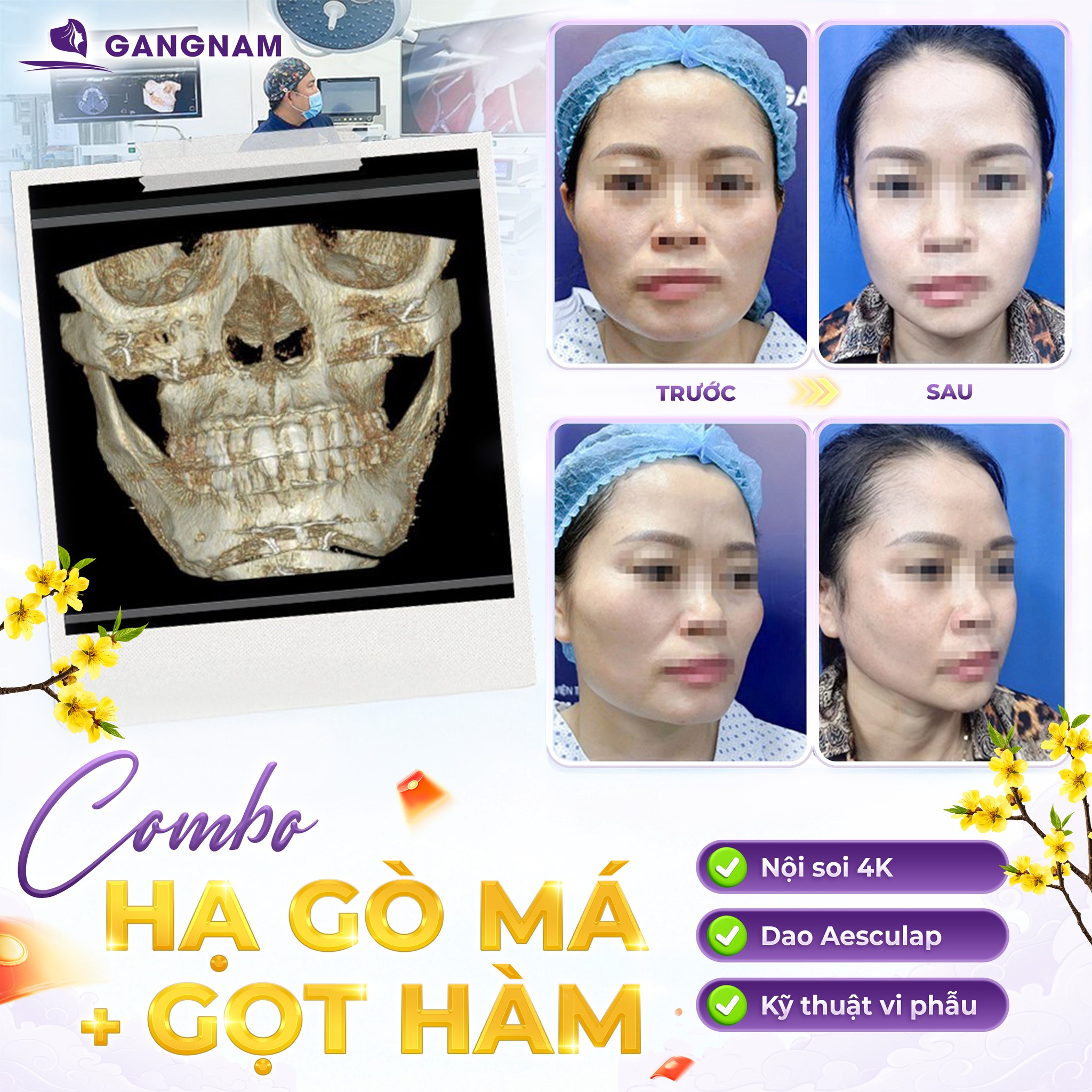 Hạ gò má tạo mặt V-line: Giải pháp thẩm mỹ hiện đại cho gương mặt thanh tú 6 Hạ gò má tạo mặt V-line an toàn, tinh tế tại Thẩm mỹ Gangnam