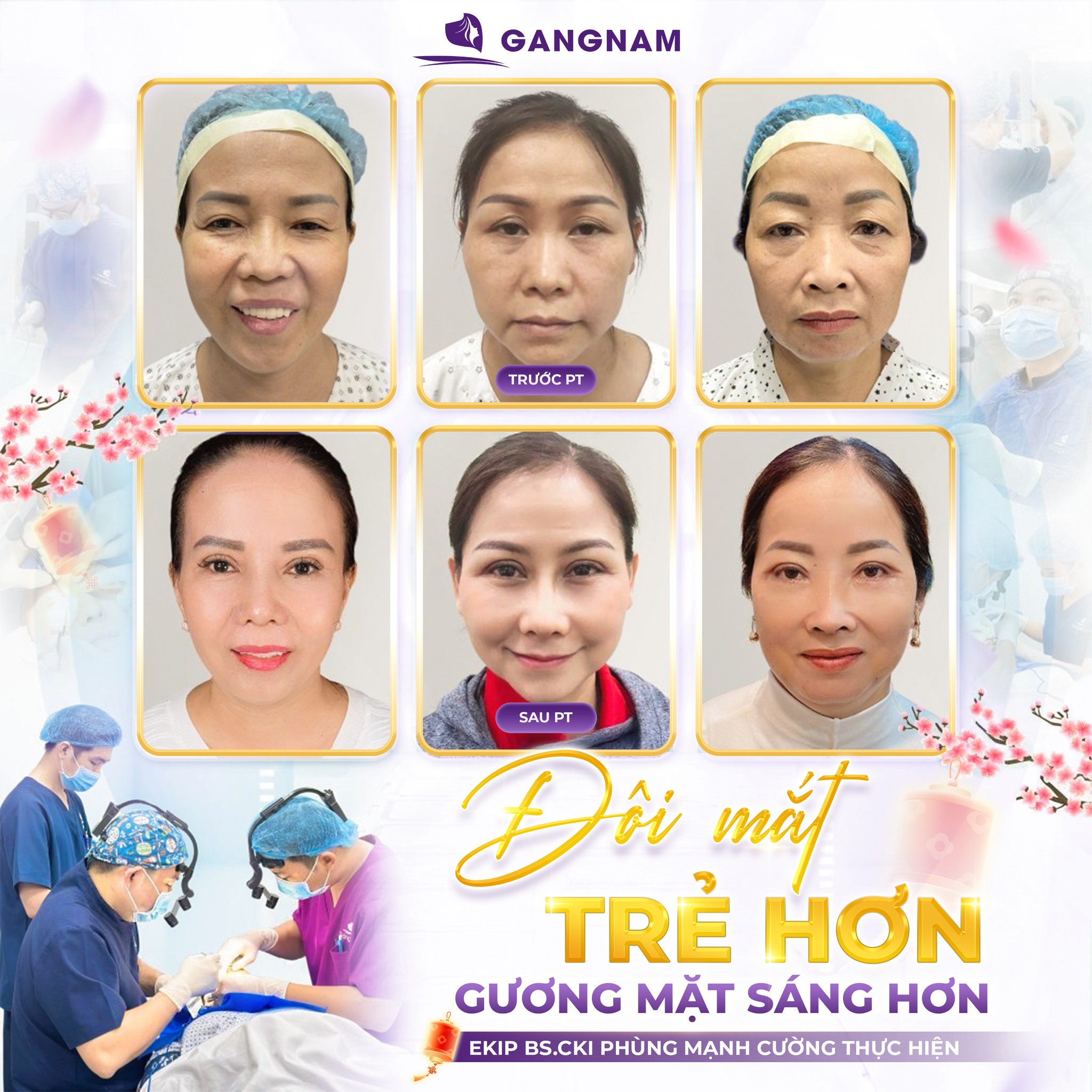 Cắt mí 4in1 thẩm mỹ – Giải pháp toàn diện cho đôi mắt hoàn hảo tự nhiên 6 Thẩm mỹ Gangnam – Chuẩn mực cắt mí 4in1 an toàn và tinh tế