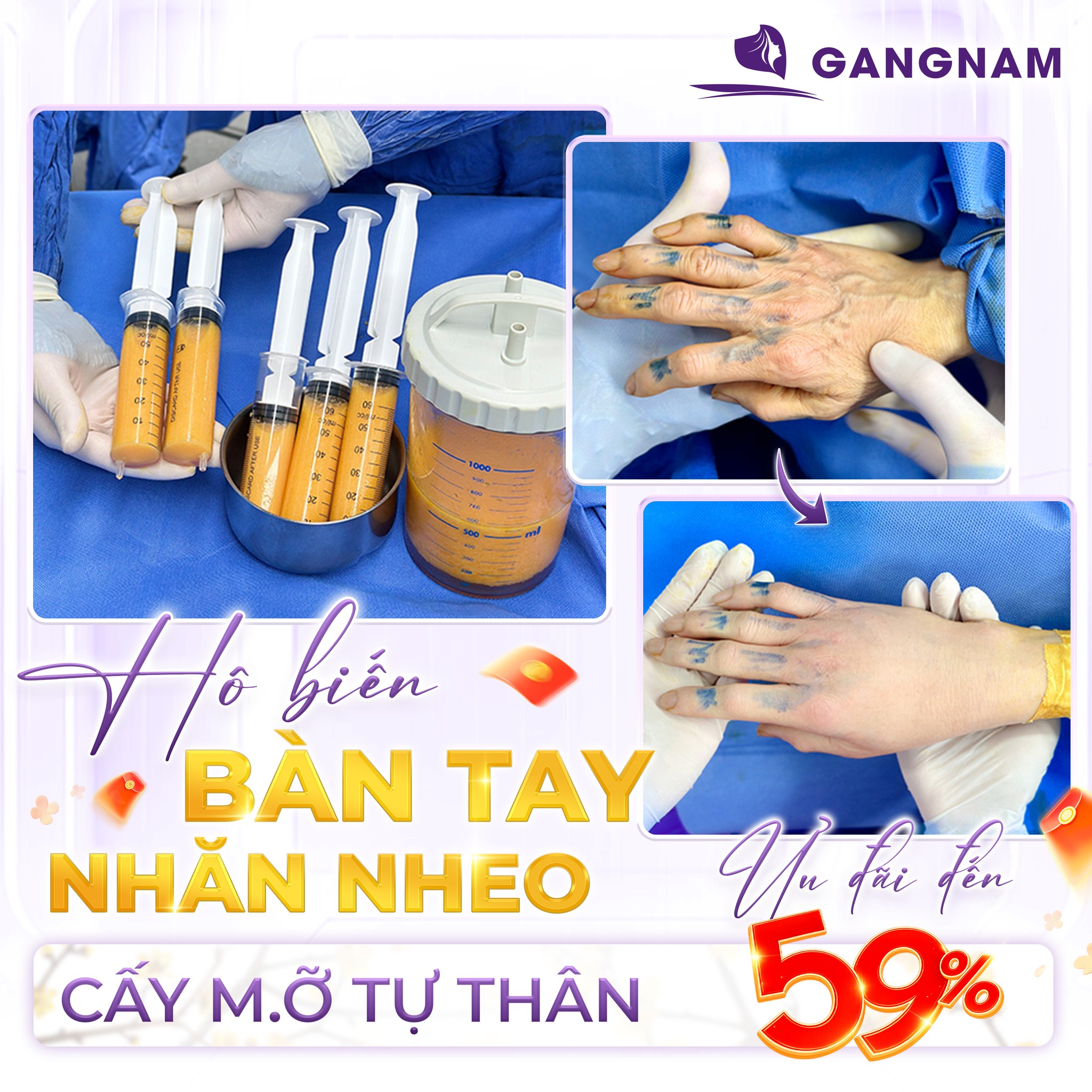 Cấy mỡ tự thân bàn tay: Giải pháp trẻ hóa đôi tay tự nhiên và bền vững 5 Đối tượng phù hợp với phương pháp cấy mỡ tự thân bàn tay