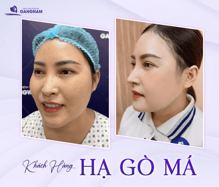 Hạ gò má tạo mặt V-line: Giải pháp thẩm mỹ hiện đại cho gương mặt thanh tú 5 Hành trình hồi phục sau phẫu thuật hạ gò má tạo mặt V-line
