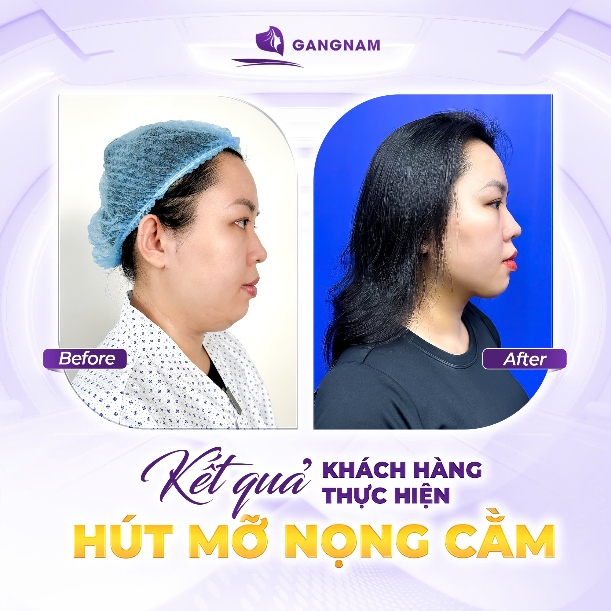 Hút mỡ nọng cằm – Giải pháp định hình đường viền hàm sắc nét 5 Quy trình thực hiện hút mỡ nọng cằm tiêu chuẩn