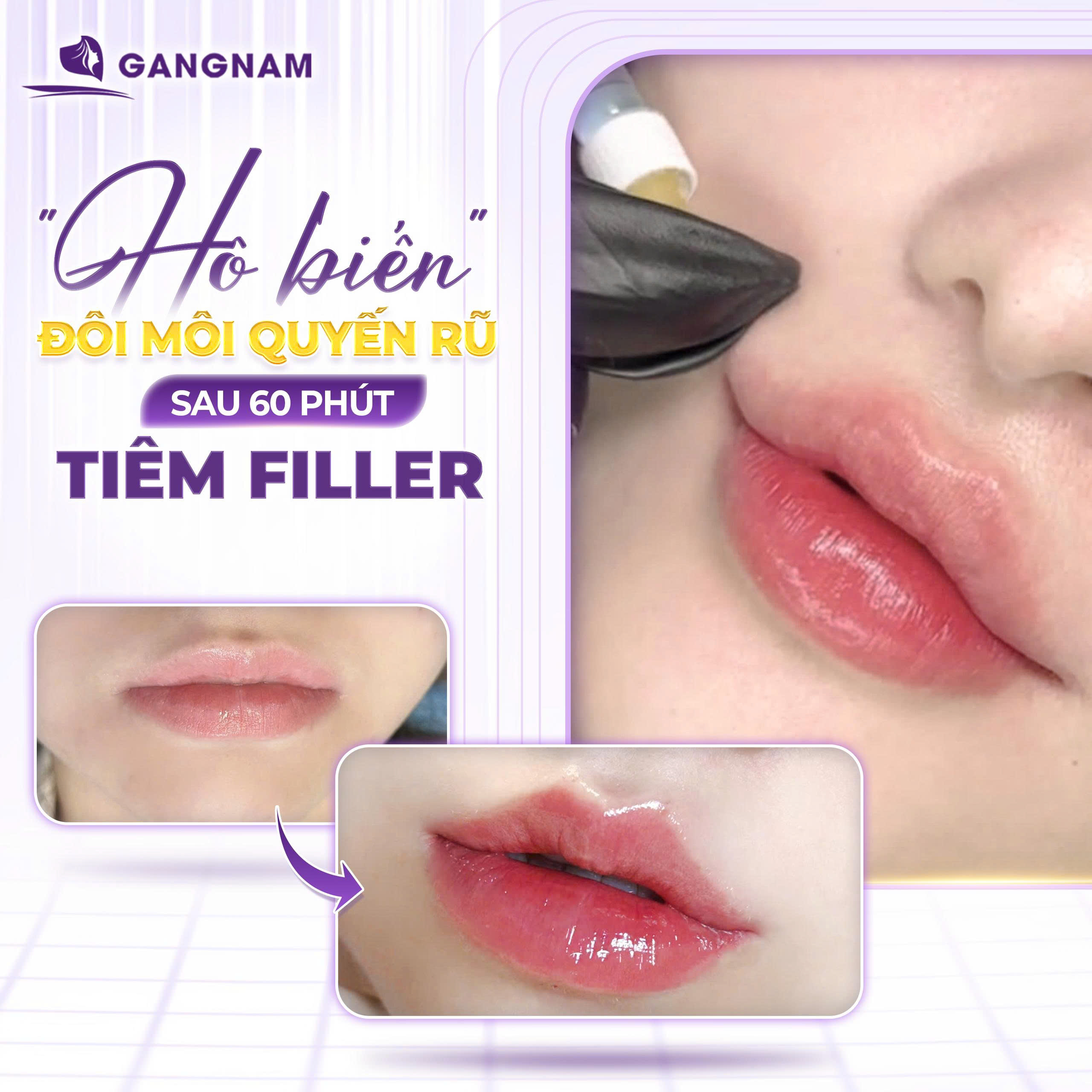 Tiêm filler môi baby: Bí quyết sở hữu đôi môi căng mọng tự nhiên và trẻ trung 5 Ưu điểm nổi bật của tiêm filler môi baby