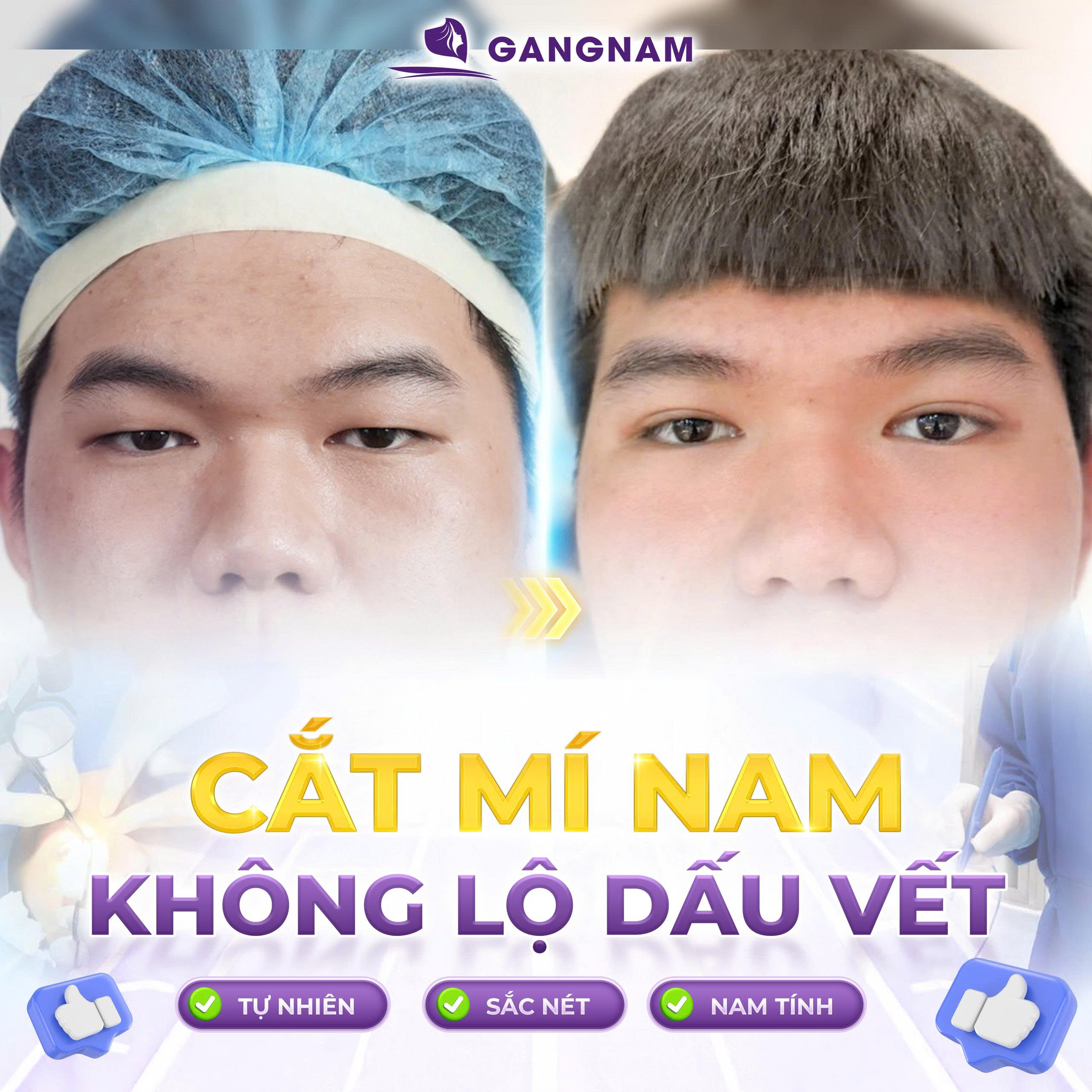 Cắt mí mắt nam: Bí quyết sở hữu ánh nhìn sắc nét và nam tính 6 Thẩm mỹ Gangnam – Địa chỉ chuẩn Hàn cho dịch vụ cắt mí mắt nam an toàn và tự nhiên