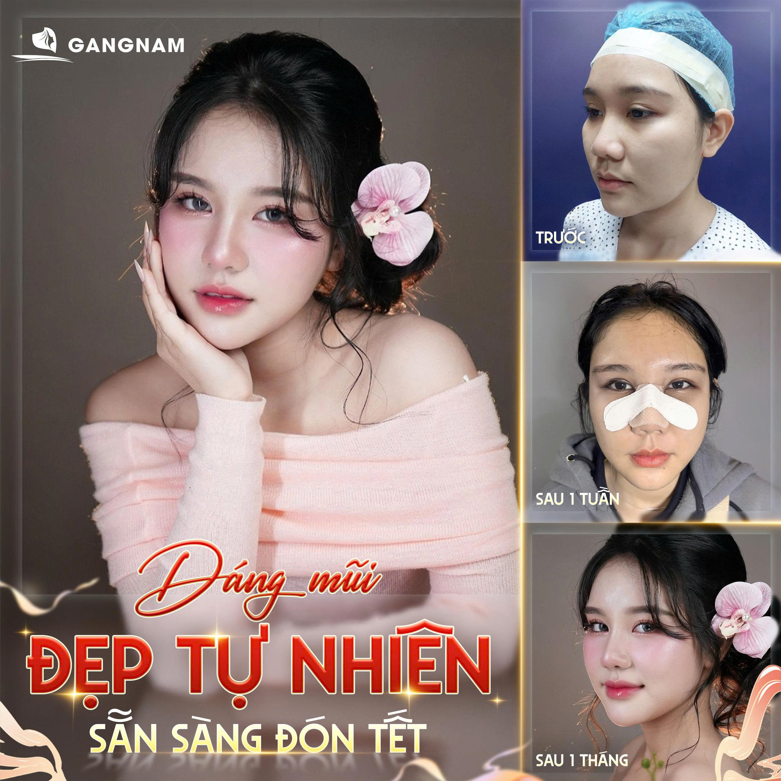 Nâng mũi dáng S-line tự nhiên – Xu hướng vẻ đẹp thanh tú chuẩn Á Đông 6 Thẩm mỹ Gangnam – Địa chỉ nâng mũi S-line tự nhiên uy tín