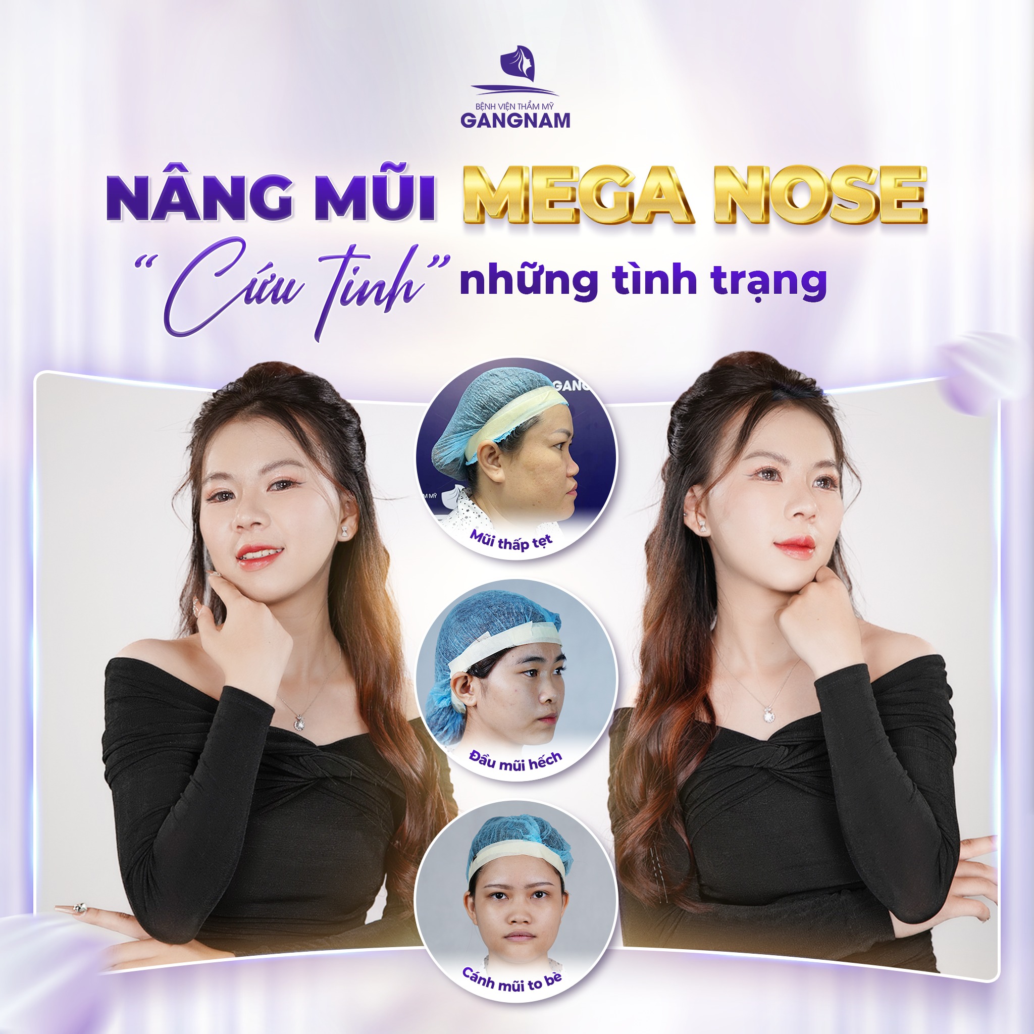 Nâng mũi Mega Nose: Bí quyết sở hữu dáng mũi tự nhiên và bền vững 4 Nâng mũi Mega Nose là gì?