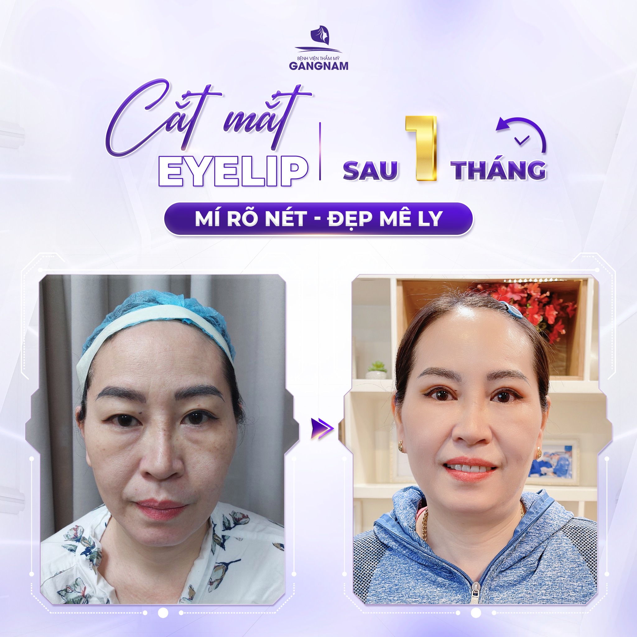 Bấm mí Eyelid – Giải pháp tạo mắt hai mí tự nhiên không cần phẫu thuật 4 Bấm mí Eyelid thực chất là gì và cơ chế hoạt động ra sao