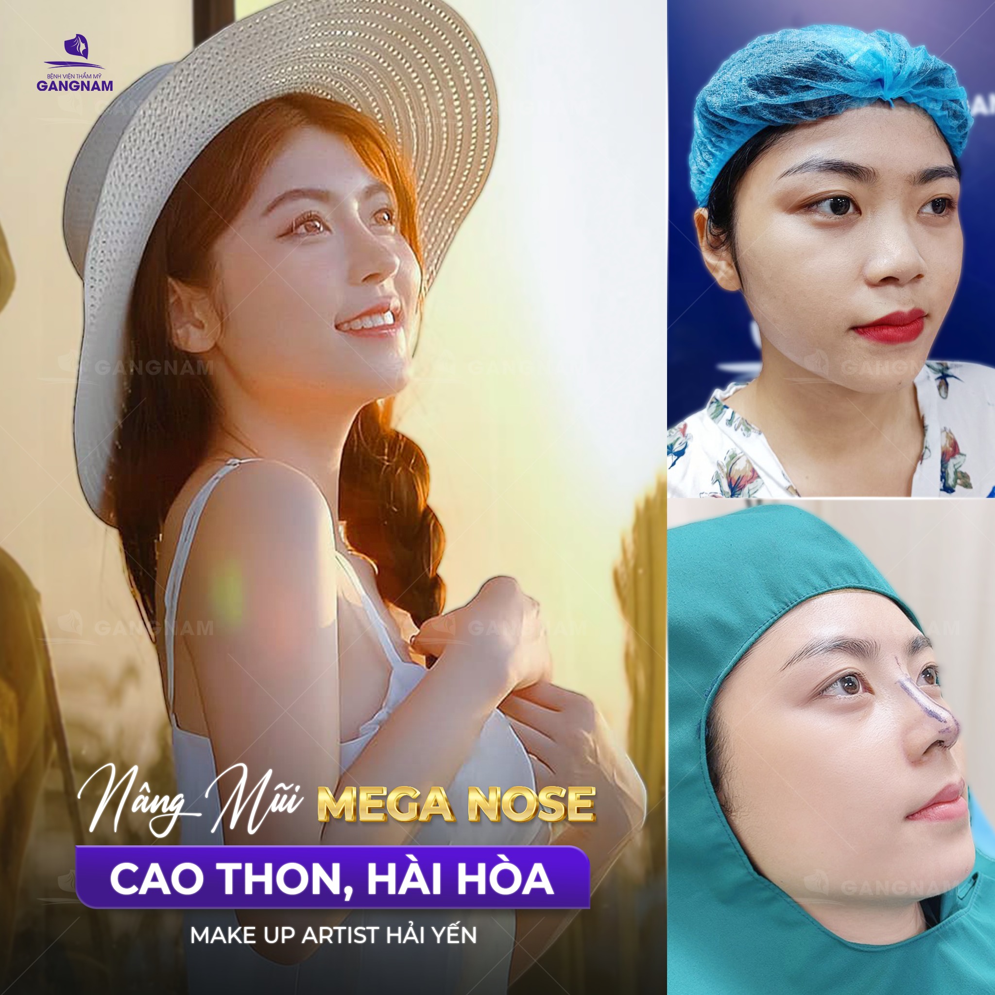 Nâng mũi Mega Nose: Bí quyết sở hữu dáng mũi tự nhiên và bền vững 6 Nâng mũi Mega Nose tại Thẩm mỹ Gangnam