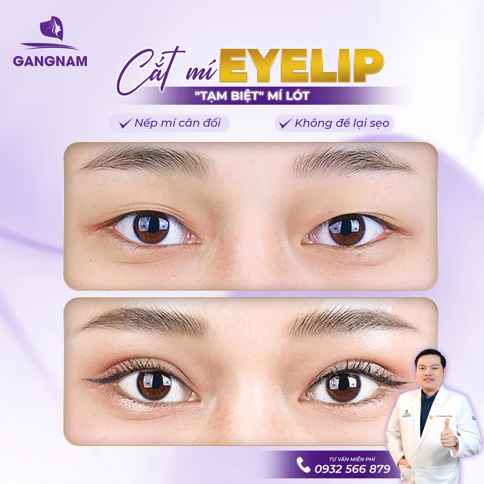 Bấm mí Eyelid – Giải pháp tạo mắt hai mí tự nhiên không cần phẫu thuật 6 Thẩm mỹ Gangnam – Địa chỉ bấm mí Eyelid được tin chọn