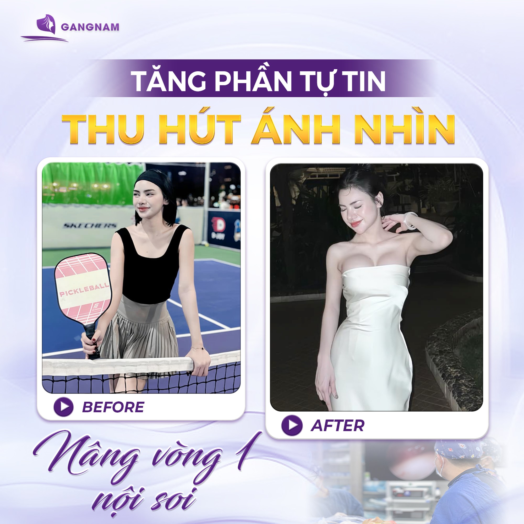 Nâng vòng 1 nội soi – Giải pháp hiện đại cho vòng ngực căng tròn tự nhiên 5 Túi độn ngực phổ biến áp dụng trong nâng vòng 1 nội soi năm 2026