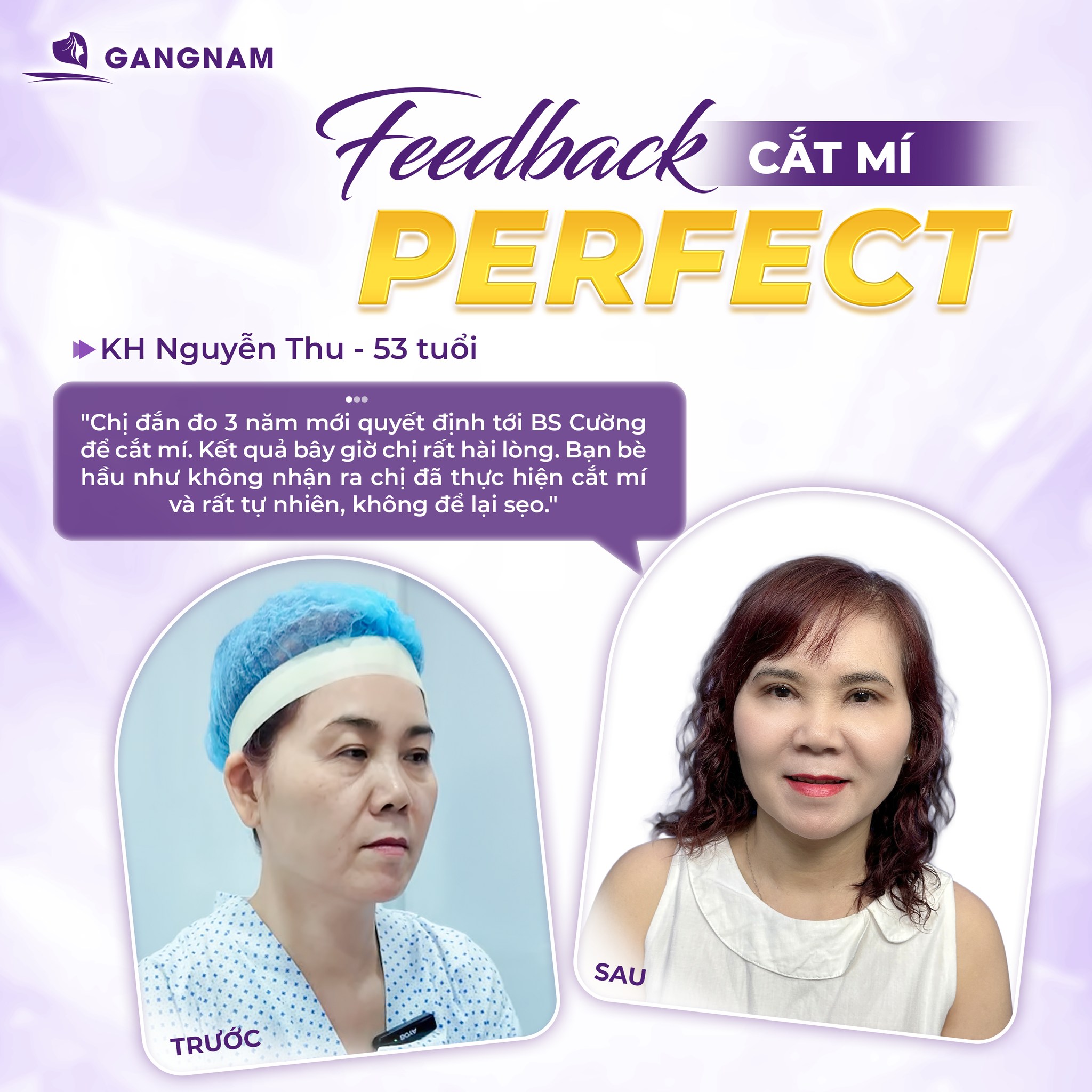 Bấm mí Perfect thẩm mỹ – Giải pháp tạo đôi mắt hai mí tự nhiên hoàn hảo 4 Bấm mí Perfect thẩm mỹ là gì và cơ chế hoạt động