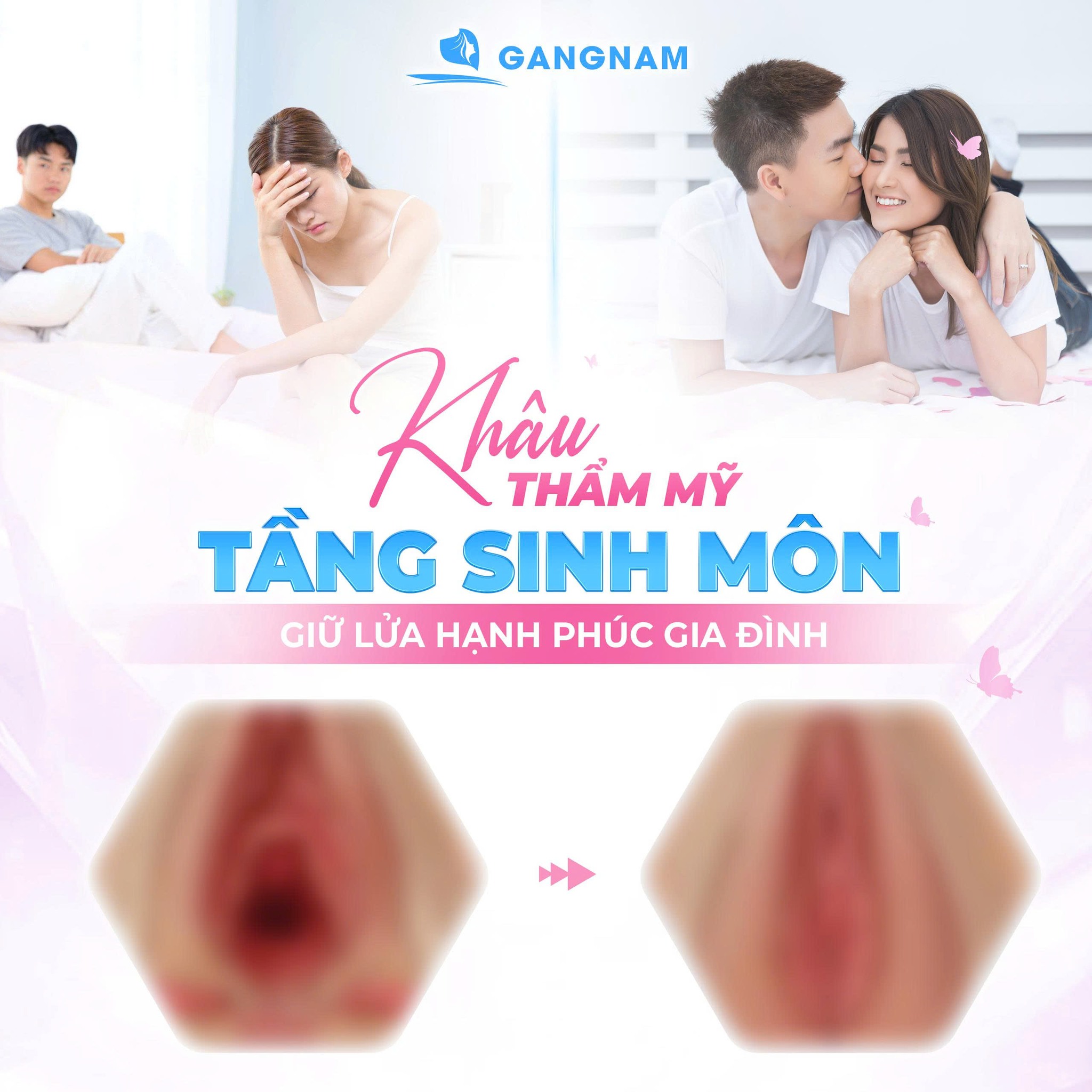 Se khít tầng sinh môn: Giải pháp phục hồi vùng kín toàn diện cho phụ nữ 4 Se khít tầng sinh môn là gì và quy trình thực hiện chi tiết