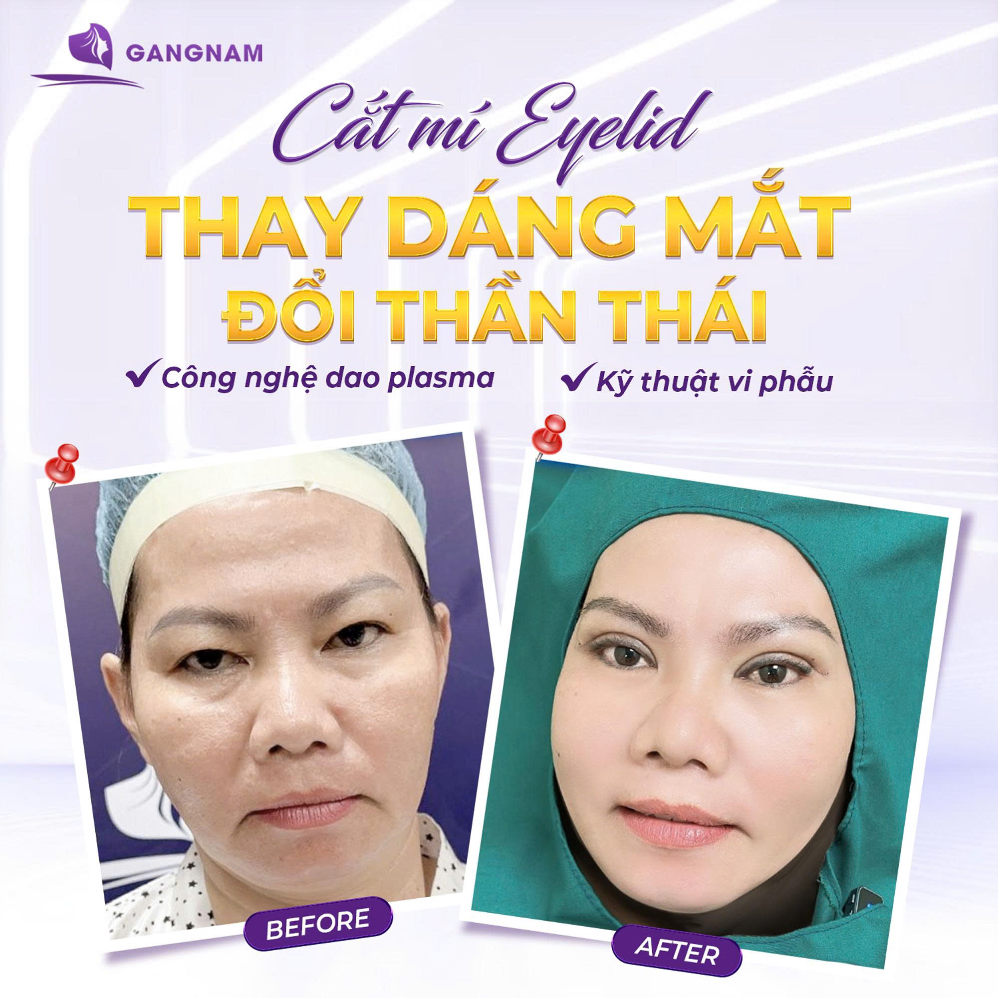 Cắt mí dưới Eyelid: Bí quyết trẻ hóa vùng mắt hiệu quả 6 Thẩm mỹ Gangnam – Địa chỉ trẻ hóa vùng mắt uy tín