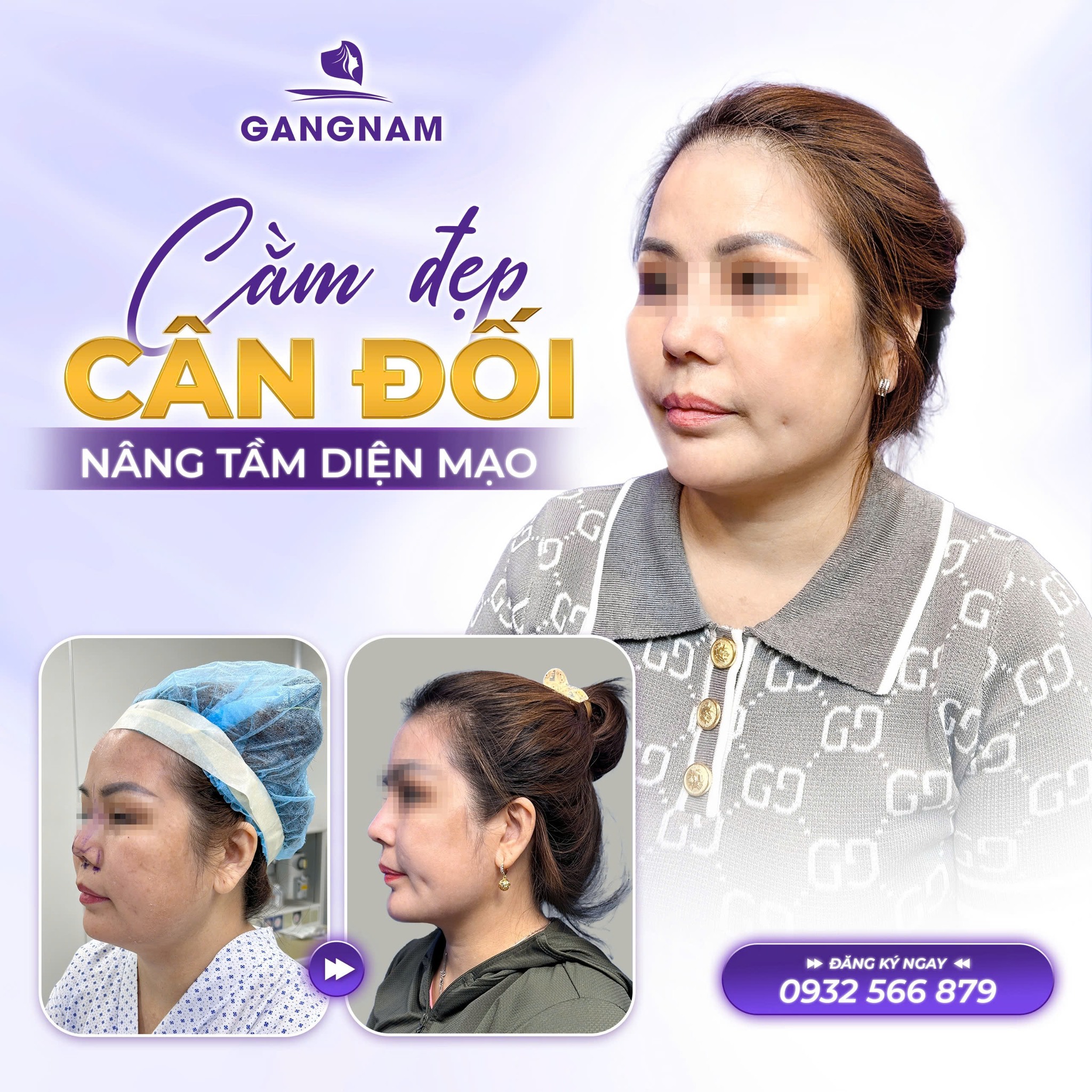 Độn cằm V-line: Giải pháp hoàn hảo cho gương mặt thanh thoát và cân đối 5 Độn cằm V-line: Giải pháp hoàn hảo cho gương mặt thanh thoát và cân đối 2