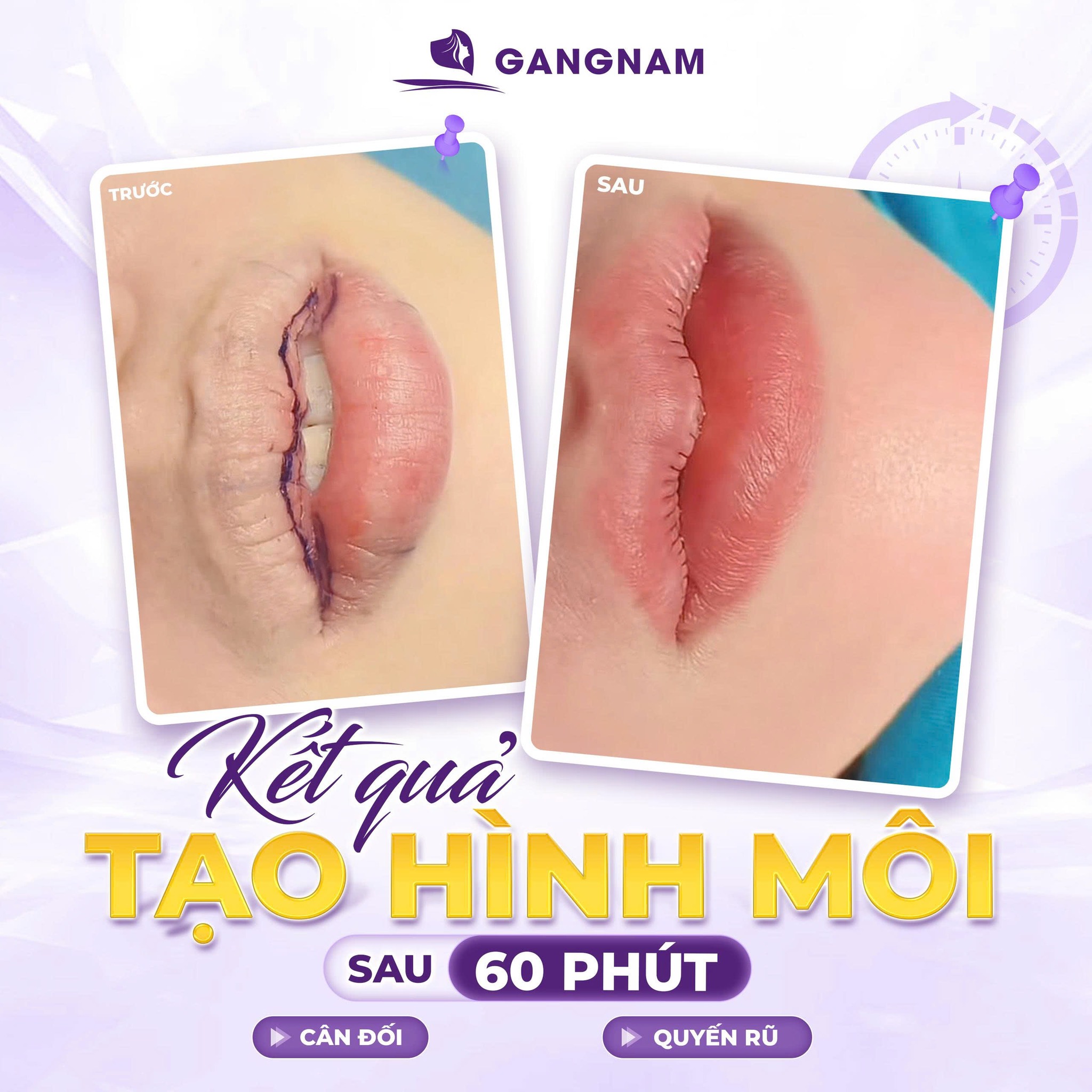 Tạo hình môi trái tim: Bí quyết sở hữu nụ cười quyến rũ vĩnh viễn 6 Tạo hình môi trái tim tại Thẩm mỹ Gangnam