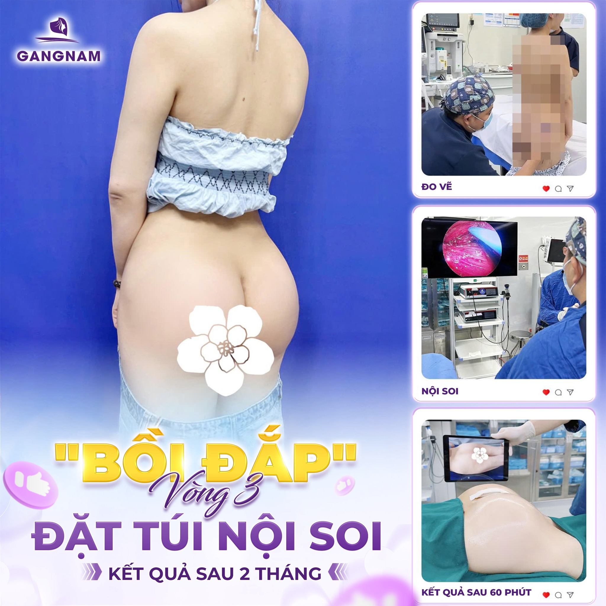 Nâng mông nội soi thẩm mỹ – Giải pháp hoàn hảo cho vòng 3 căng tròn tự nhiên 4 Nâng mông nội soi thẩm mỹ là gì và tại sao ngày càng phổ biến?