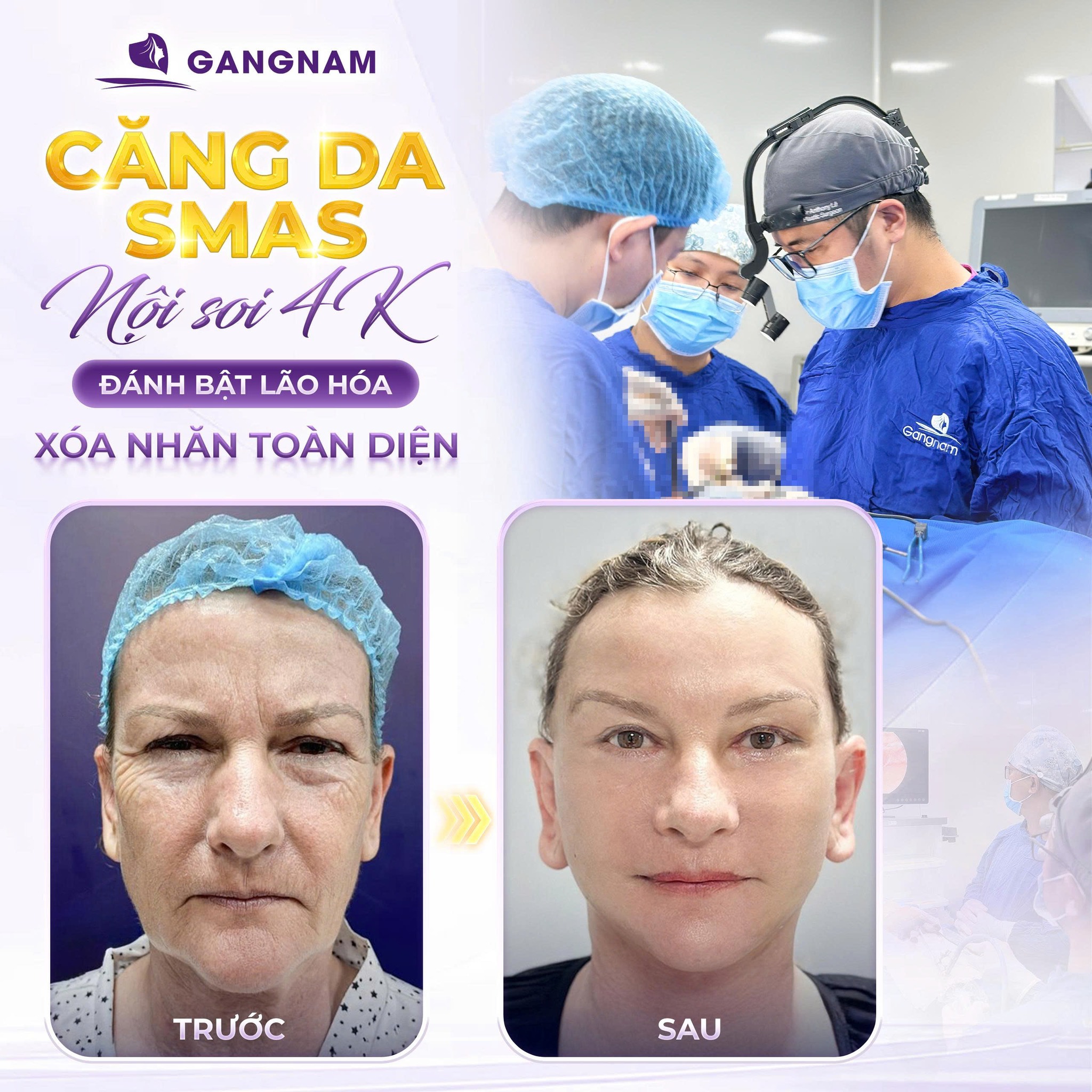 Căng da smas nội soi 4k: Phương pháp trẻ hóa khuôn mặt tiên tiến 4 Căng da smas nội soi 4k là gì