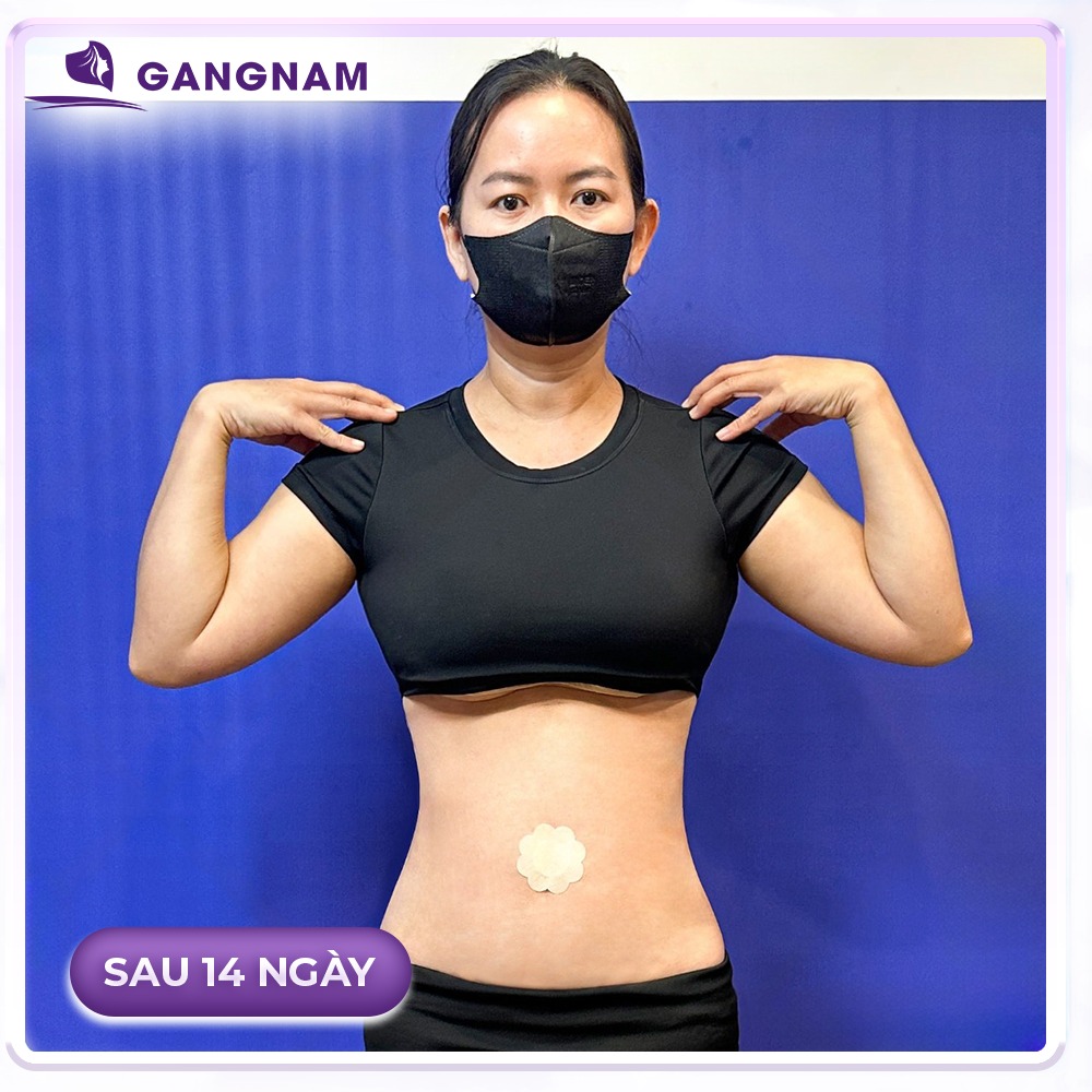 Hút mỡ vòng 2 lipo: Bí quyết sở hữu vòng eo thon gọn và săn chắc 4 Hút mỡ vòng 2 lipo là gì và lợi ích nổi bật