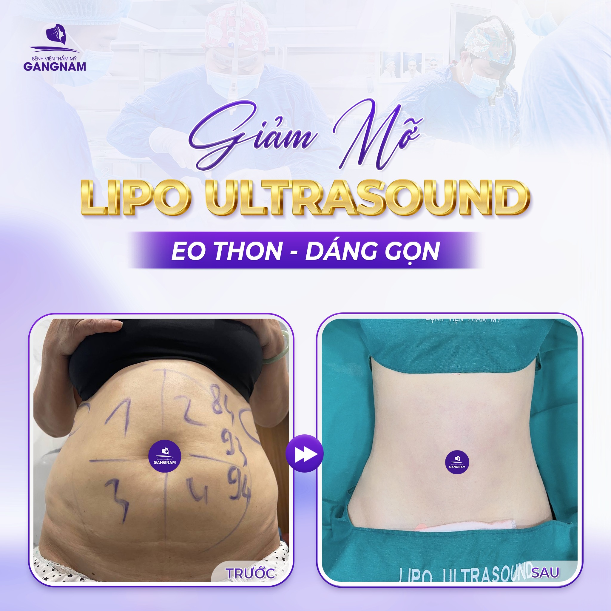 Giảm mỡ eo Lipo – Giải pháp công nghệ cao lấy lại vòng eo thon gọn 6 Thẩm mỹ Gangnam – Địa chỉ làm đẹp uy tín với công nghệ hiện đại