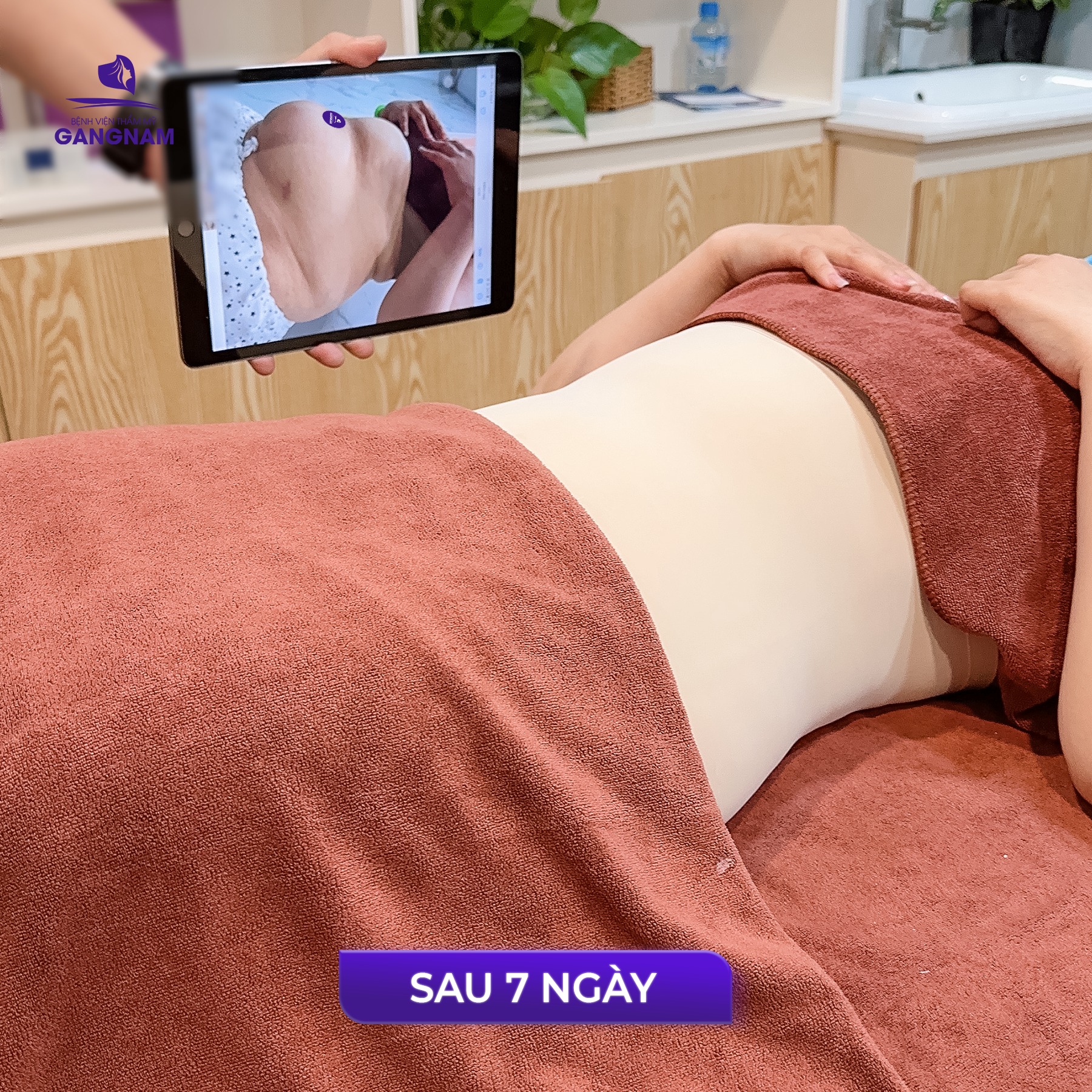 Hút mỡ hông – giải pháp loại bỏ mỡ thừa cứng đầu tạo vòng eo thon gọn 5 Hút mỡ hông có an toàn và phù hợp với ai