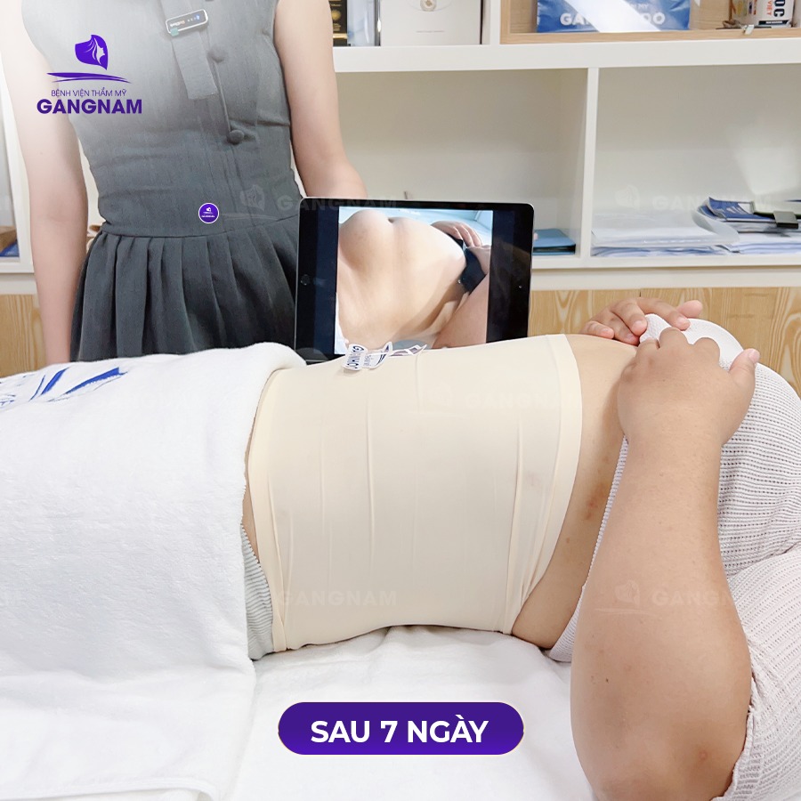 Hút mỡ vòng eo Lipo – Giải pháp lấy lại vòng eo thon gọn nhanh chóng 4 Hút mỡ vòng eo Lipo là gì và cơ chế hoạt động