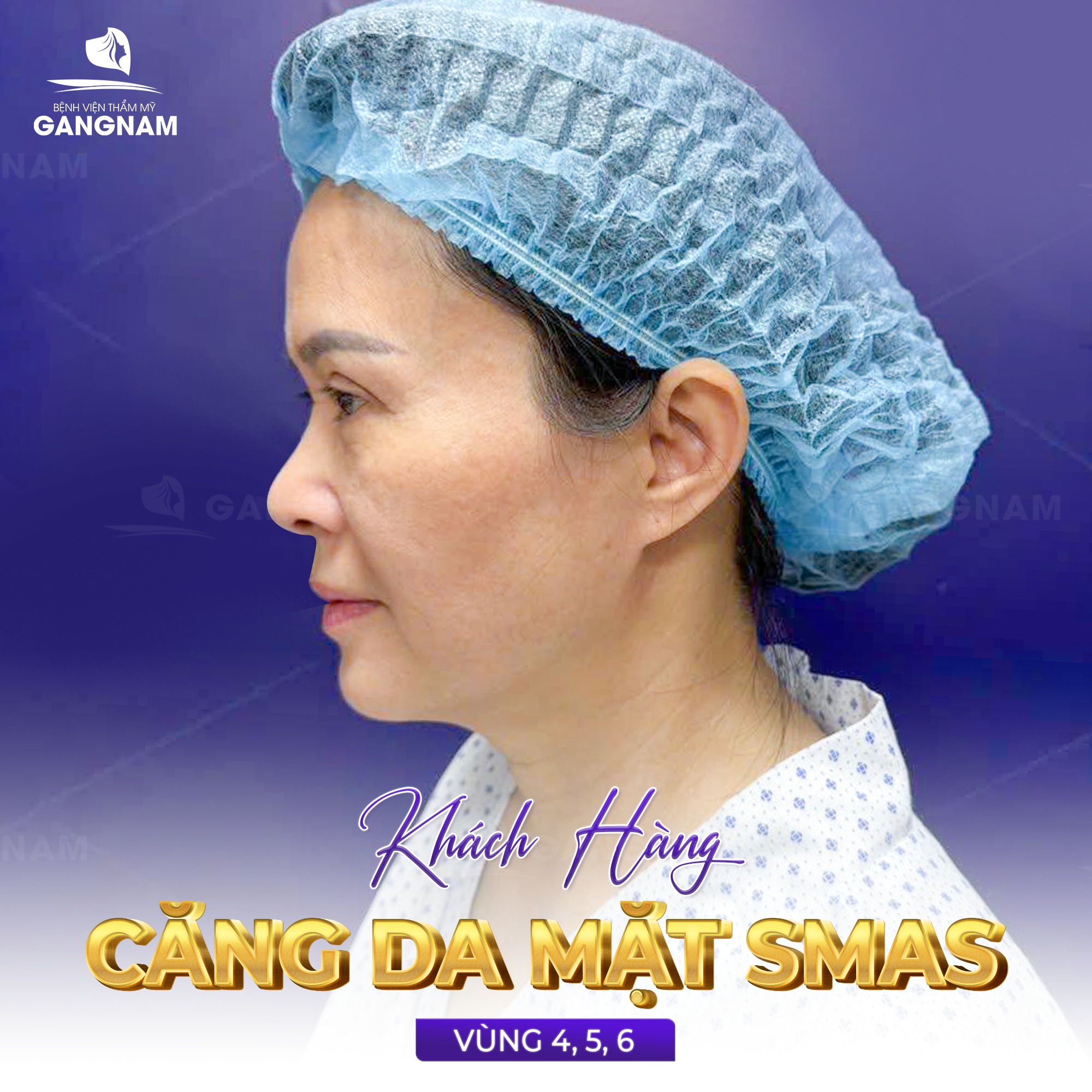 Nâng cơ mặt SMAS – Giải pháp trẻ hóa toàn diện và bền vững nhất hiện nay 4 Nâng cơ mặt SMAS là gì và tại sao lại quan trọng trong trẻ hóa da mặt?
