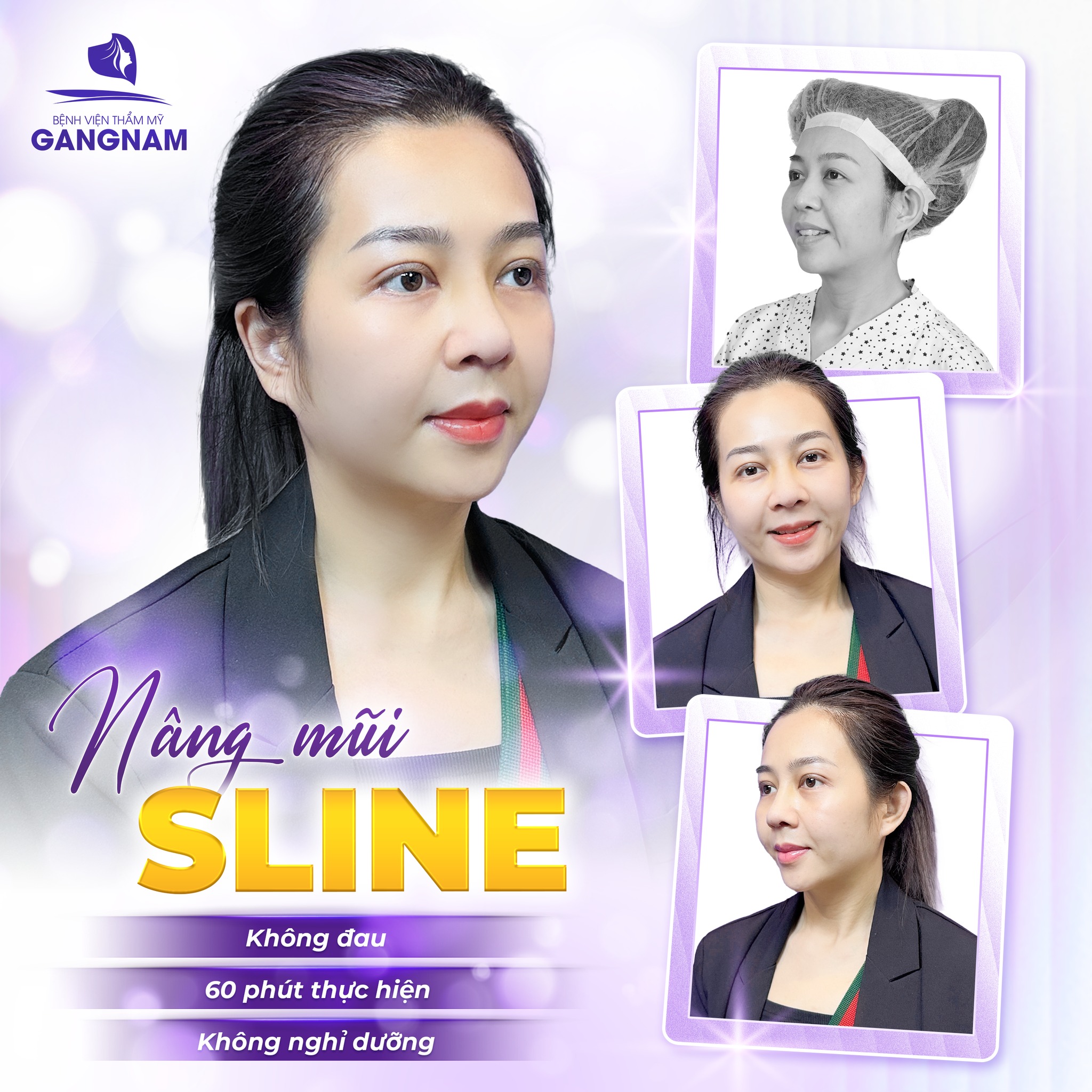 Sửa mũi Sline nội soi – Giải pháp hoàn hảo cho dáng mũi thanh tú tự nhiên 6 Sửa mũi Sline nội soi an toàn, dáng mũi tự nhiên tại Thẩm mỹ Gangnam