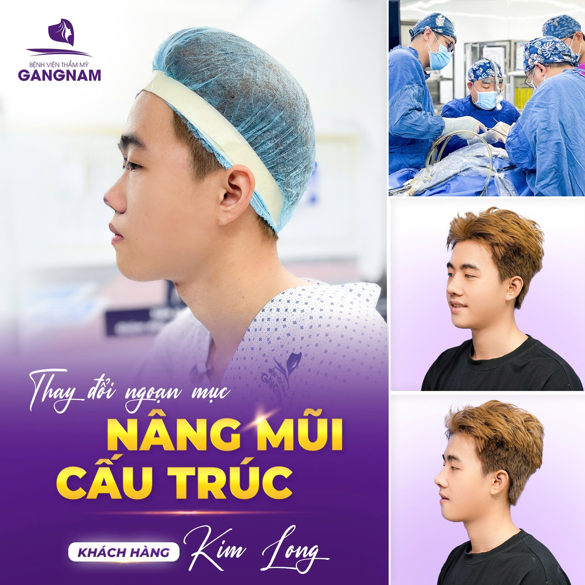 Nâng mũi cấu trúc nội soi: Giải pháp tái tạo dáng mũi toàn diện, an toàn 6 Nâng mũi cấu trúc nội soi tại Thẩm mỹ Gangnam