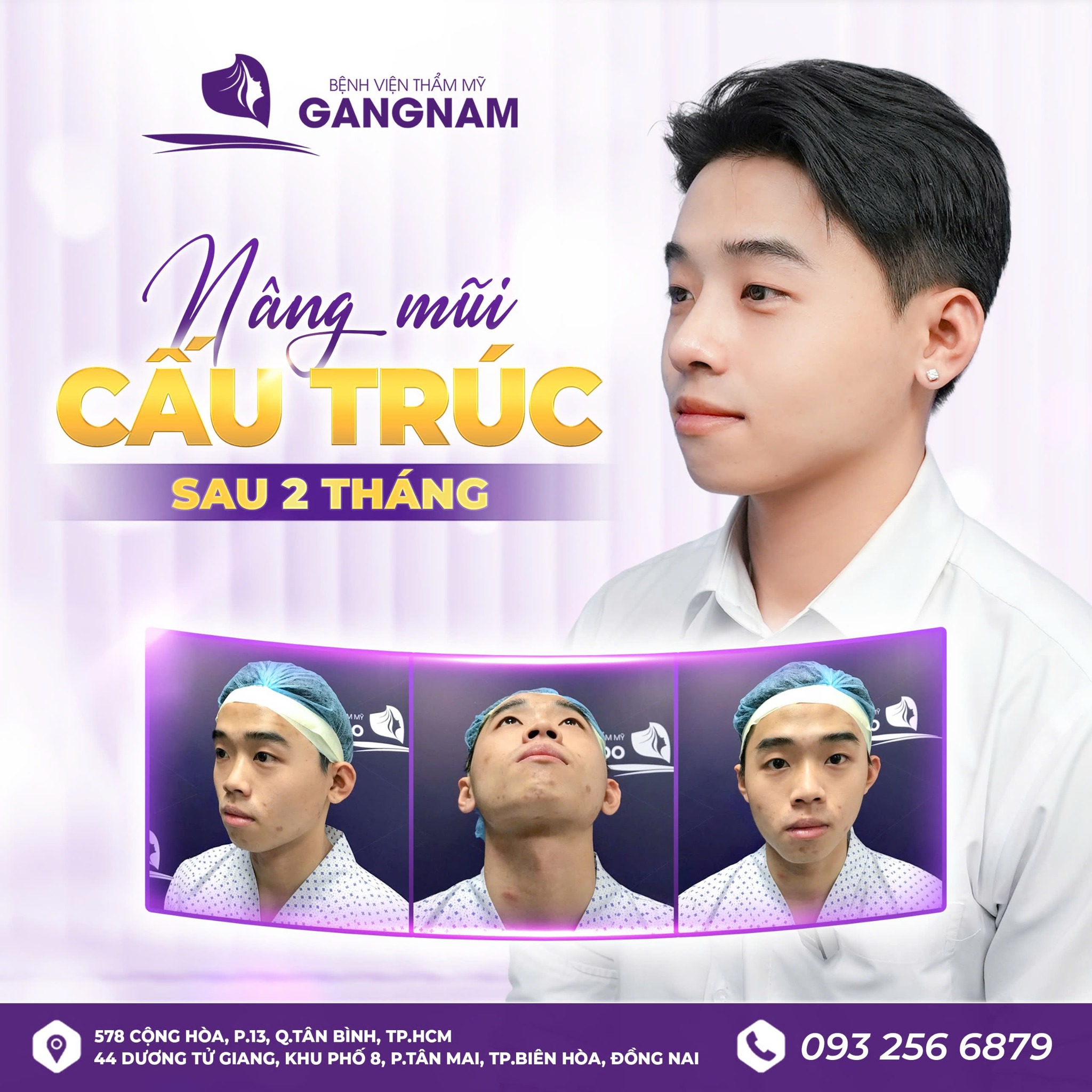 Nâng mũi cấu trúc nội soi: Giải pháp tái tạo dáng mũi toàn diện, an toàn 4 Nâng mũi cấu trúc nội soi là gì