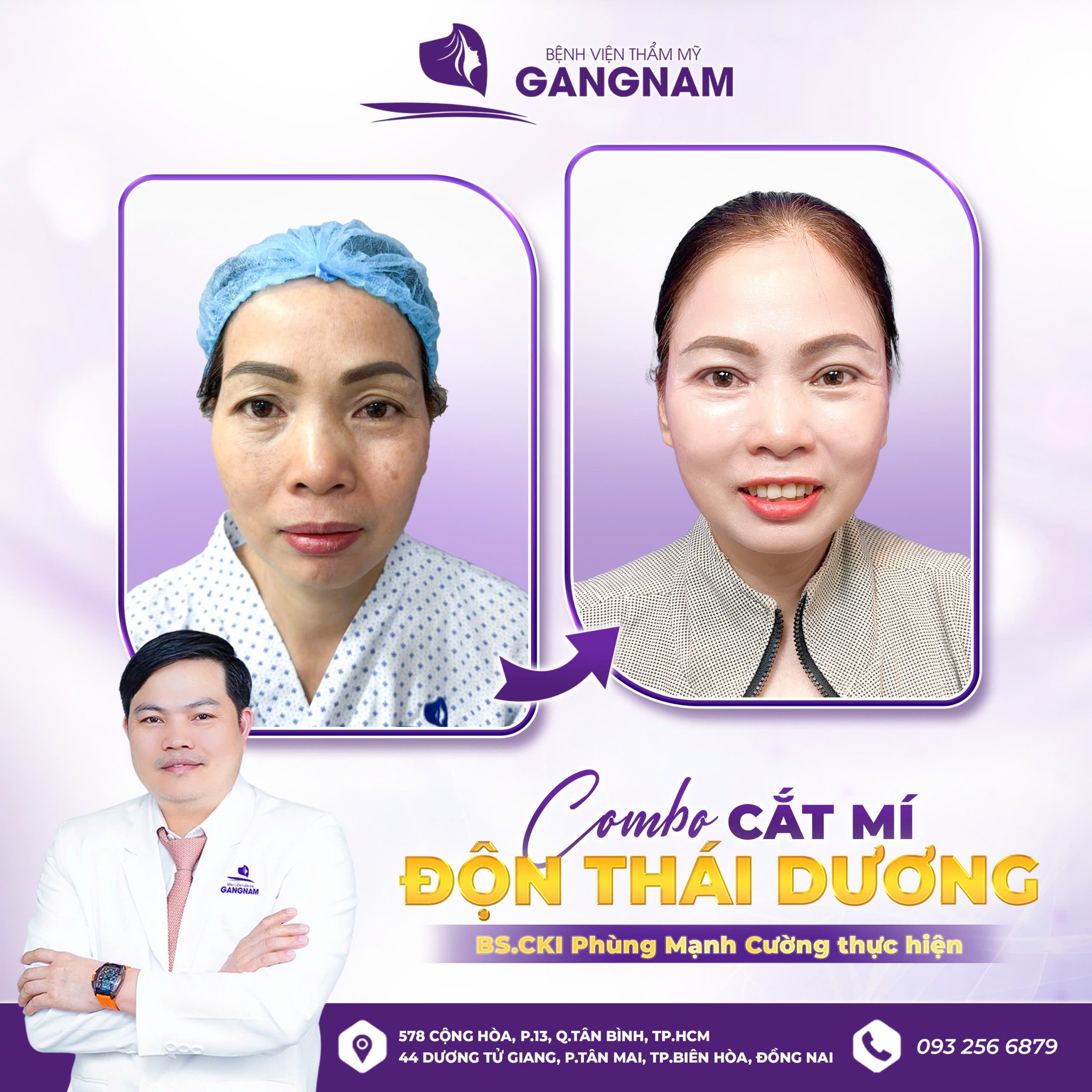 Độn thái dương – Giải pháp làm đầy vùng thái dương lõm, mang lại gương mặt hài hòa 5 Chất liệu độn phổ biến trong độn thái dương: Silicone và Surgiform