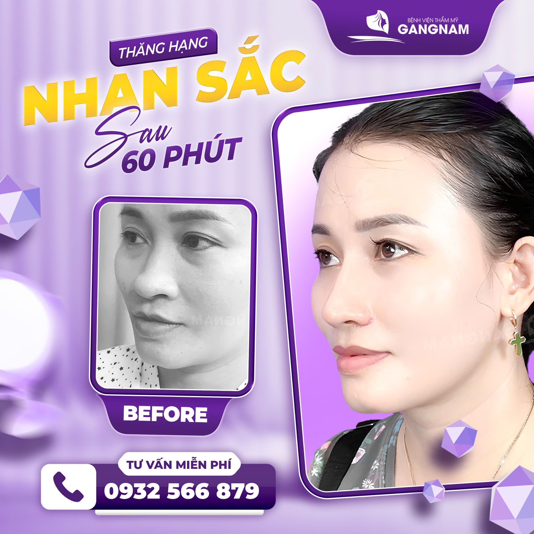 Nâng mũi công nghệ nội soi 4k – giải pháp thẩm mỹ mũi chính xác và an toàn 5 Đối tượng phù hợp để thực hiện nâng mũi công nghệ nội soi 4k