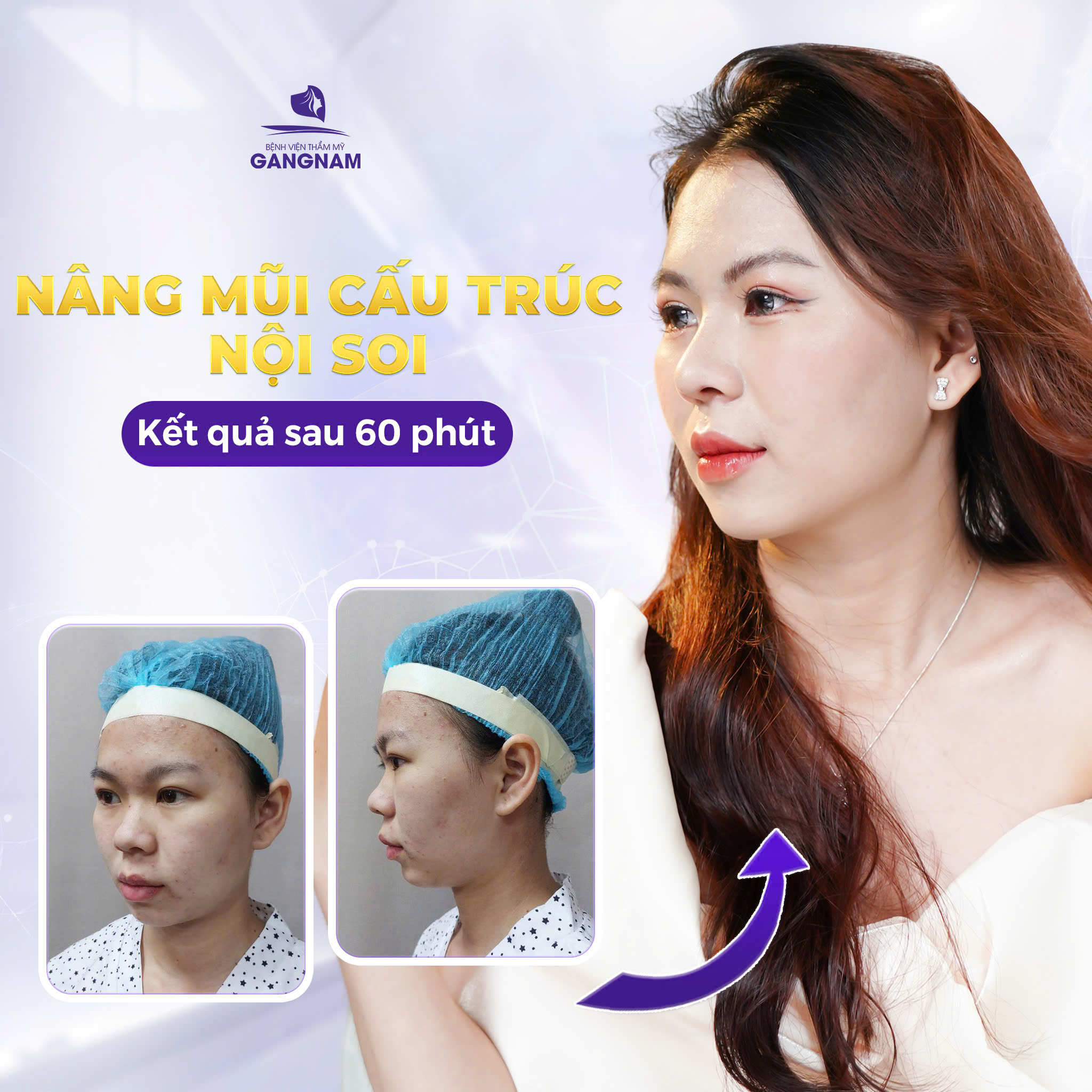 Nâng Mũi Cấu Trúc Thẩm Mỹ: Giải Pháp Tái Tạo Dáng Mũi Đẹp Tự Nhiên 5 Nguyên liệu sử dụng trong nâng mũi cấu trúc thẩm mỹ