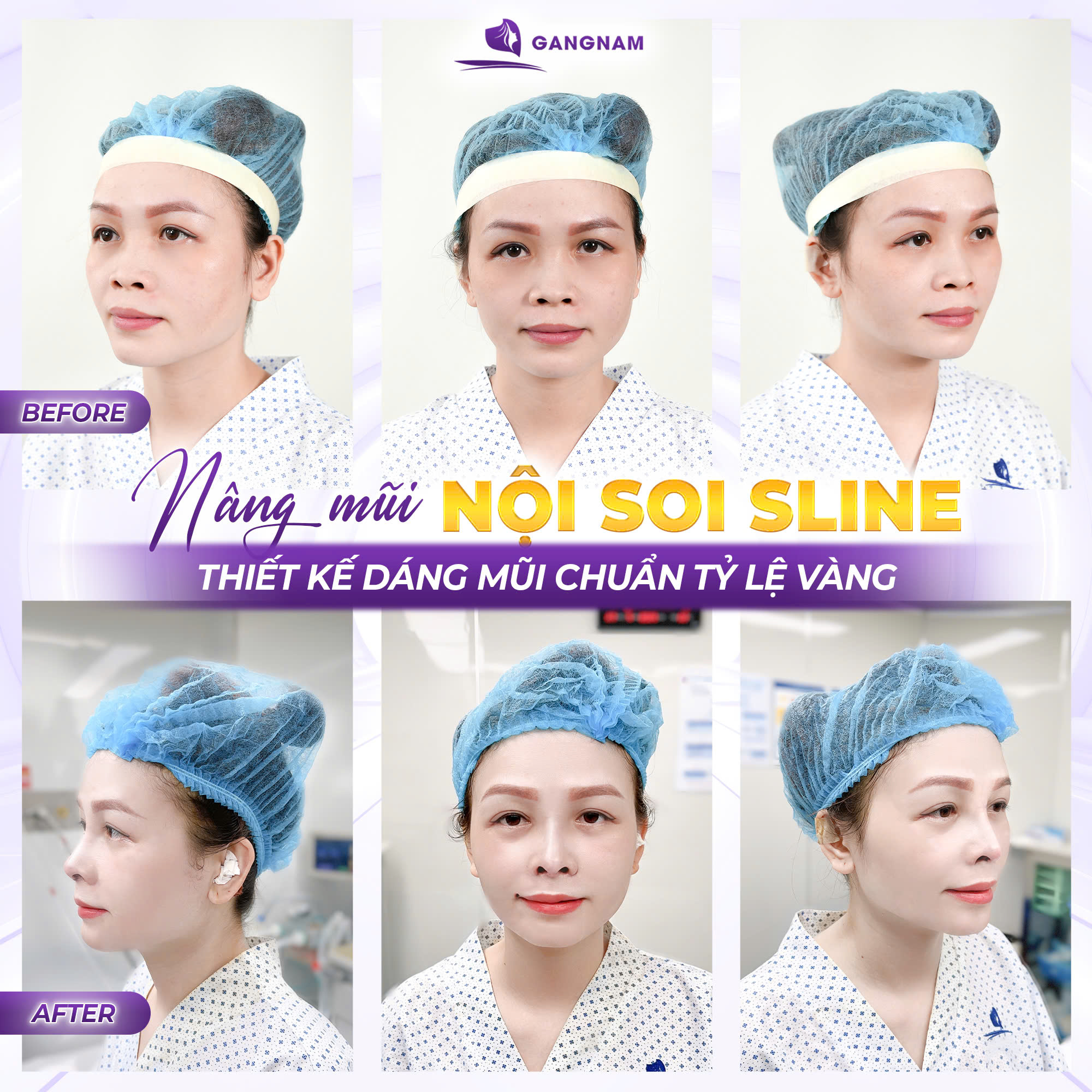 Nâng mũi công nghệ nội soi 4k – giải pháp thẩm mỹ mũi chính xác và an toàn 4 Nâng mũi công nghệ nội soi 4k là gì?