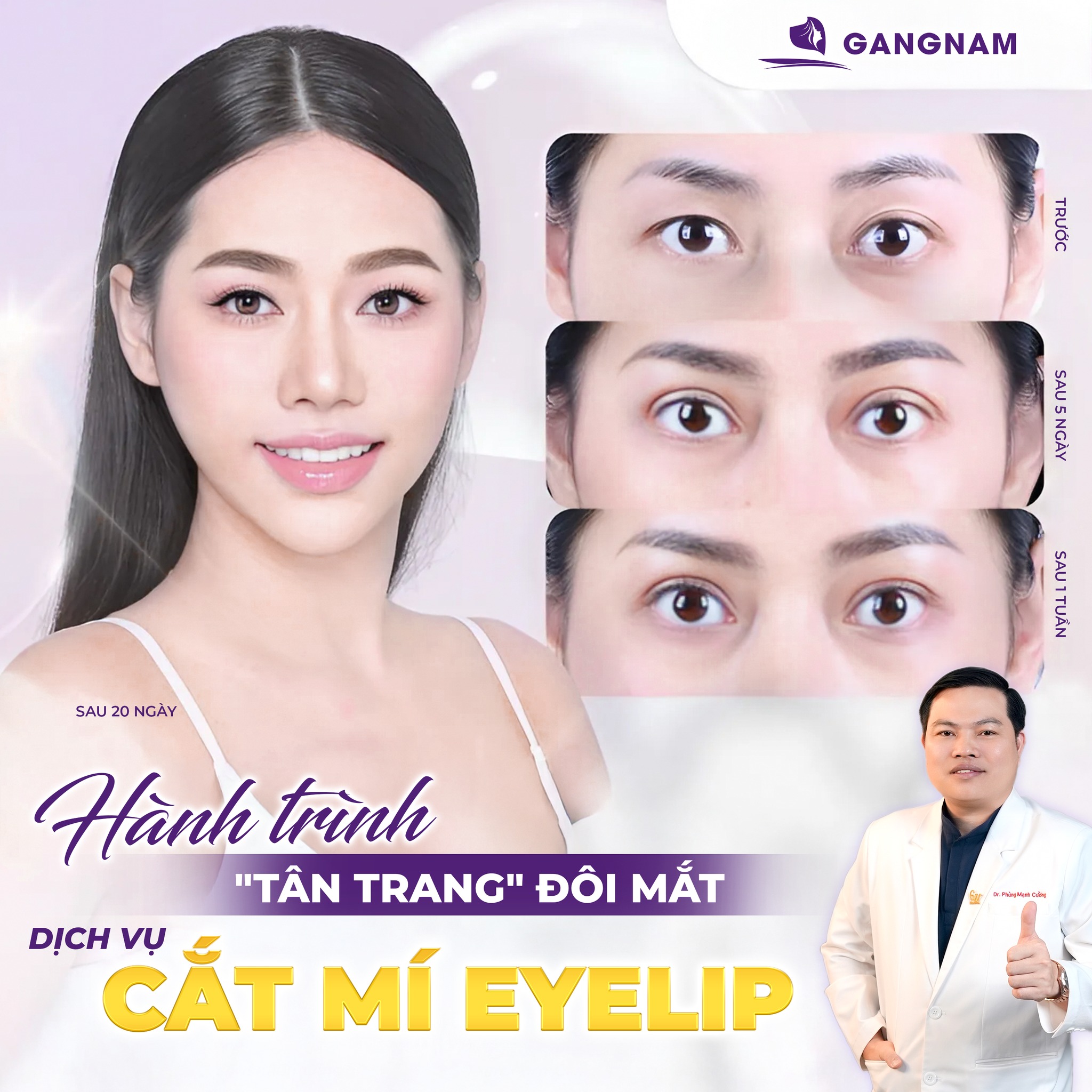 Cắt mí mắt Eyelid – Giải pháp hoàn hảo cho đôi mắt hai mí tự nhiên 6 Thẩm mỹ Gangnam – Nâng tầm nhan sắc với công nghệ hiện đại