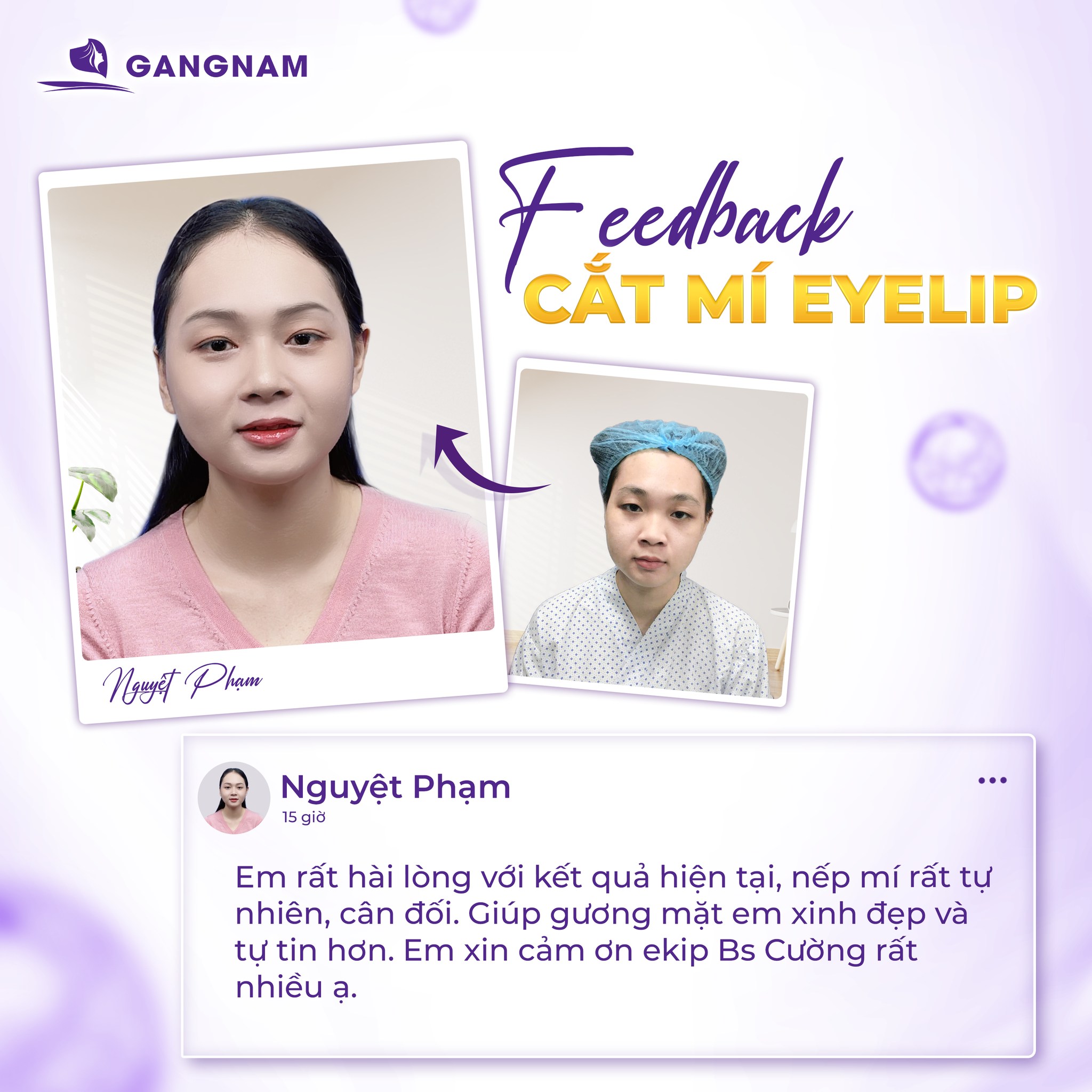 Cắt mí mắt Eyelid – Giải pháp hoàn hảo cho đôi mắt hai mí tự nhiên 5 Cắt mí mắt Eyelid – Giải pháp hoàn hảo cho đôi mắt hai mí tự nhiên 2