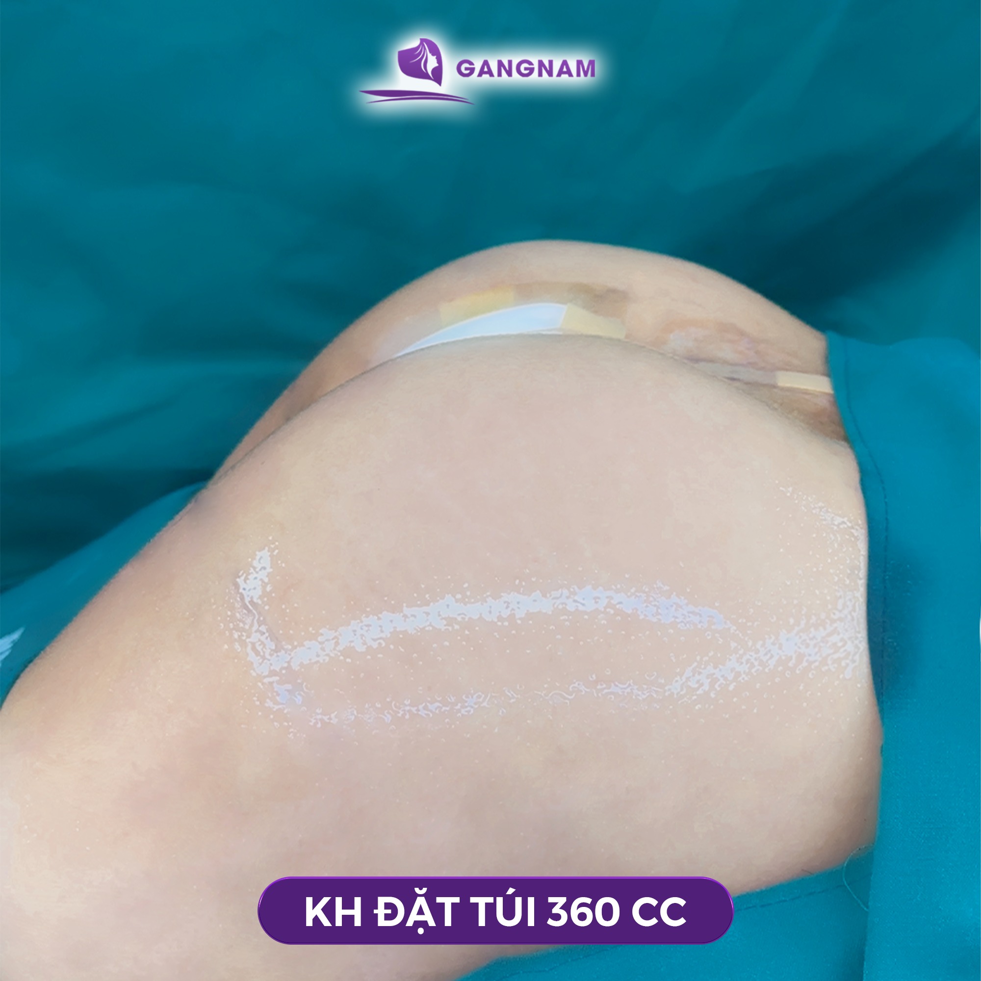 Nâng mông túi silicon – Giải pháp tạo vòng 3 căng tròn bền vững cho người gầy 5 Kỹ thuật đặt túi trong nâng mông túi silicon