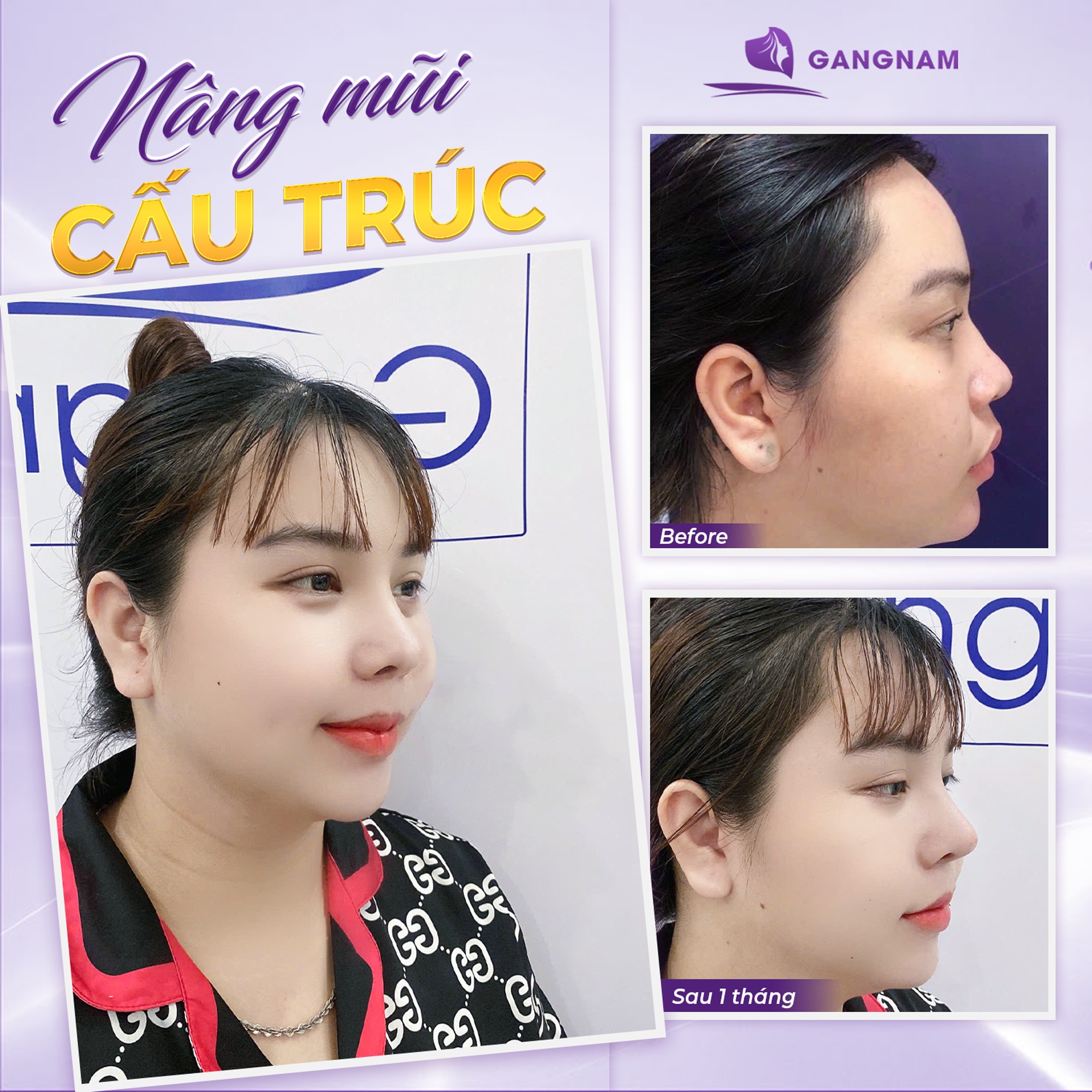 Nâng Mũi Cấu Trúc Thẩm Mỹ: Giải Pháp Tái Tạo Dáng Mũi Đẹp Tự Nhiên 4 Nâng mũi cấu trúc thẩm mỹ là gì?