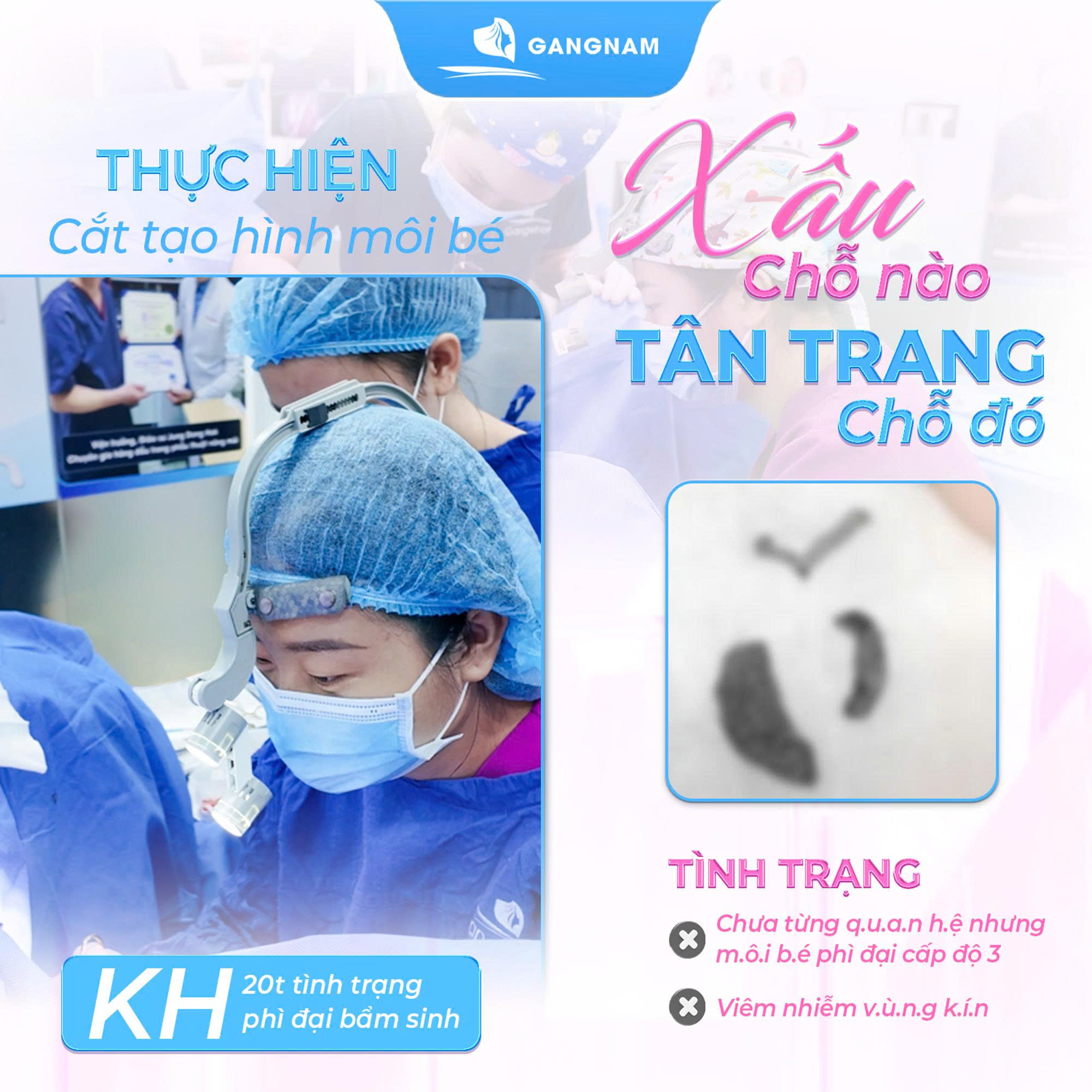 Phẫu thuật tạo hình môi bé: Giải pháp thẩm mỹ và sức khỏe vùng kín hiện đại 6 Phẫu thuật tạo hình môi bé an toàn, thẩm mỹ tự nhiên tại Thẩm mỹ Gangnam
