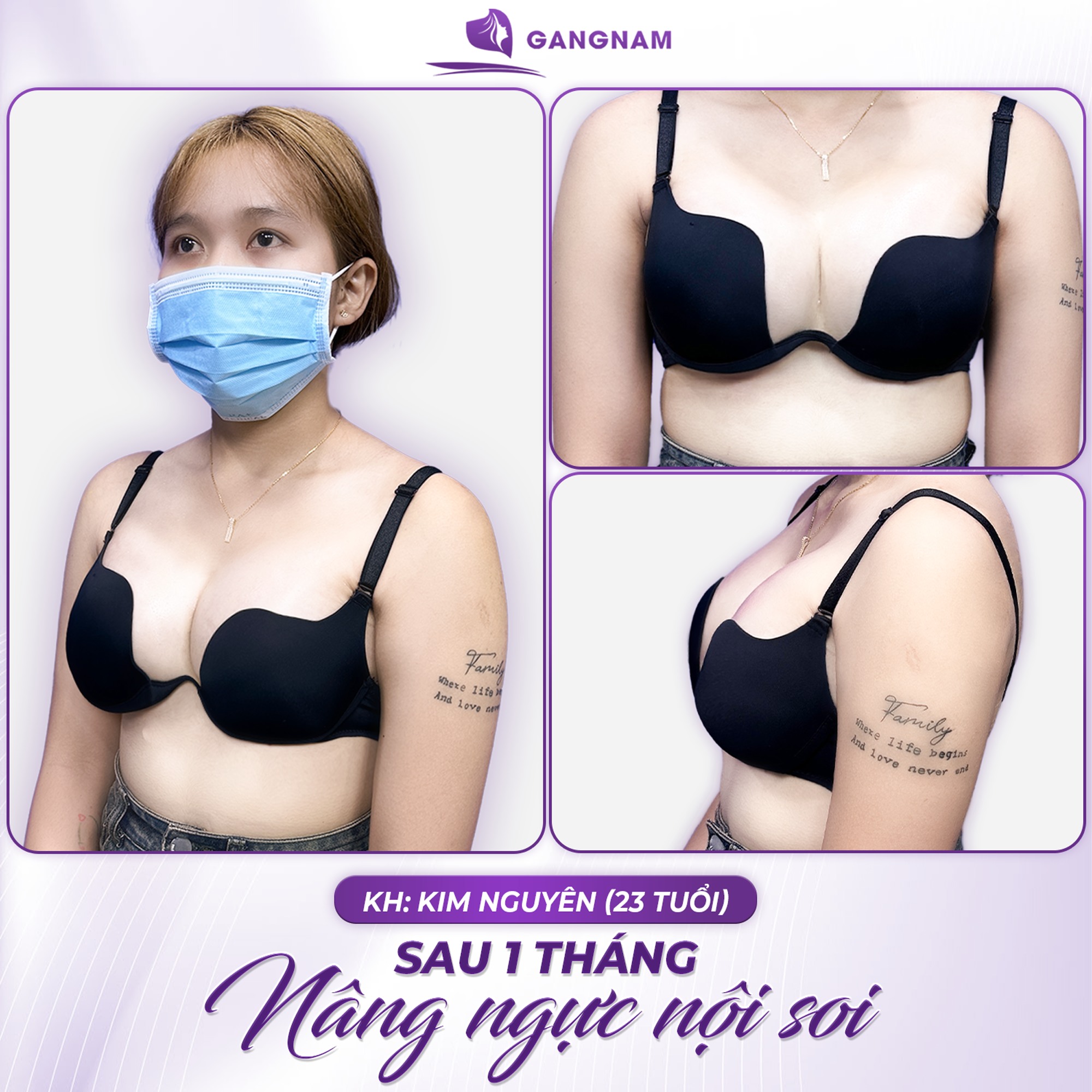 Sửa ngực nội soi 4K – Giải pháp hoàn hảo cho vòng 1 tự nhiên và an toàn 6 Sửa ngực nội soi 4K an toàn, chính xác tại Thẩm mỹ Gangnam