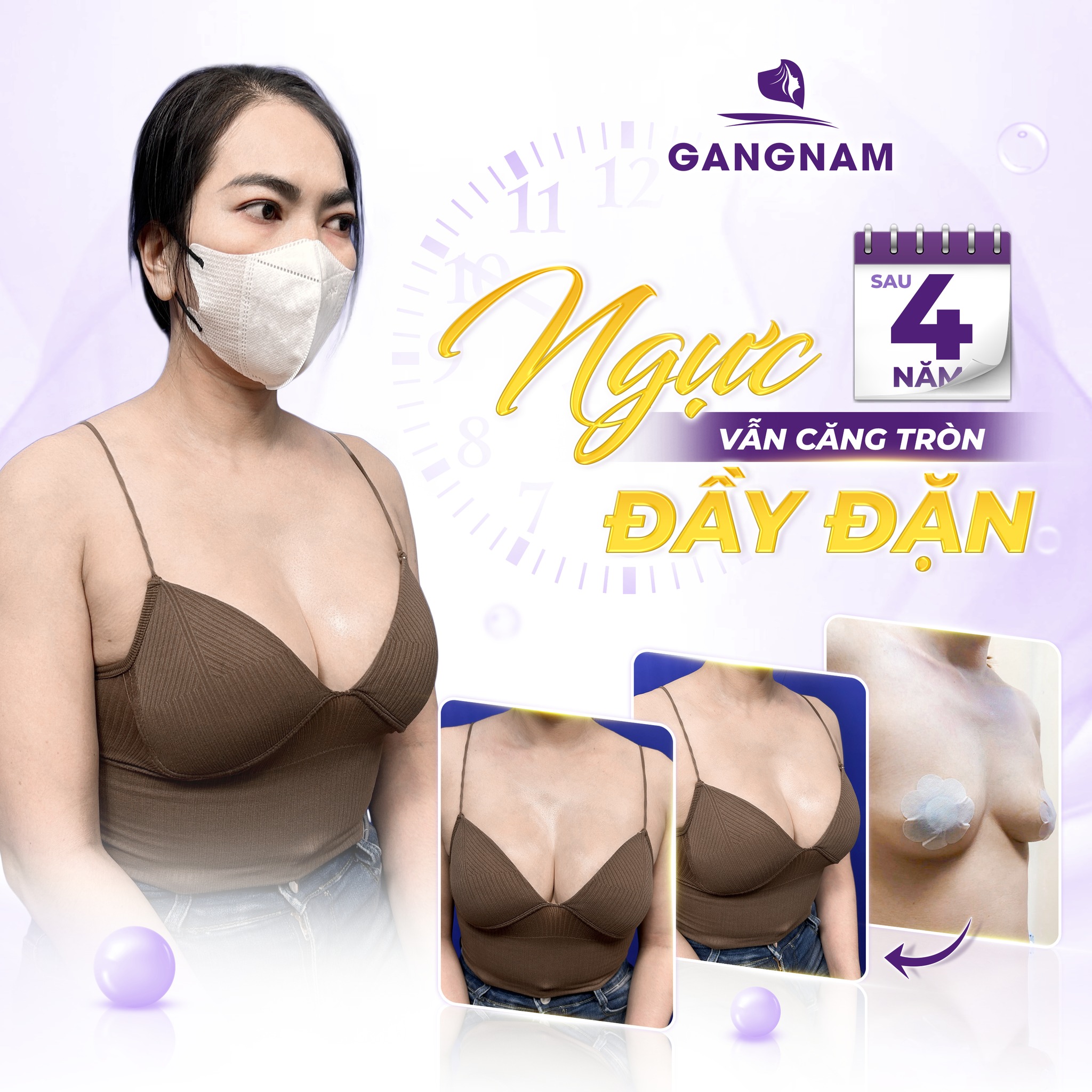 Sửa ngực nội soi 4K – Giải pháp hoàn hảo cho vòng 1 tự nhiên và an toàn 5 Kỹ thuật Dual Plane kết hợp sửa ngực nội soi 4K – Bí quyết cho vòng 1 tự nhiên