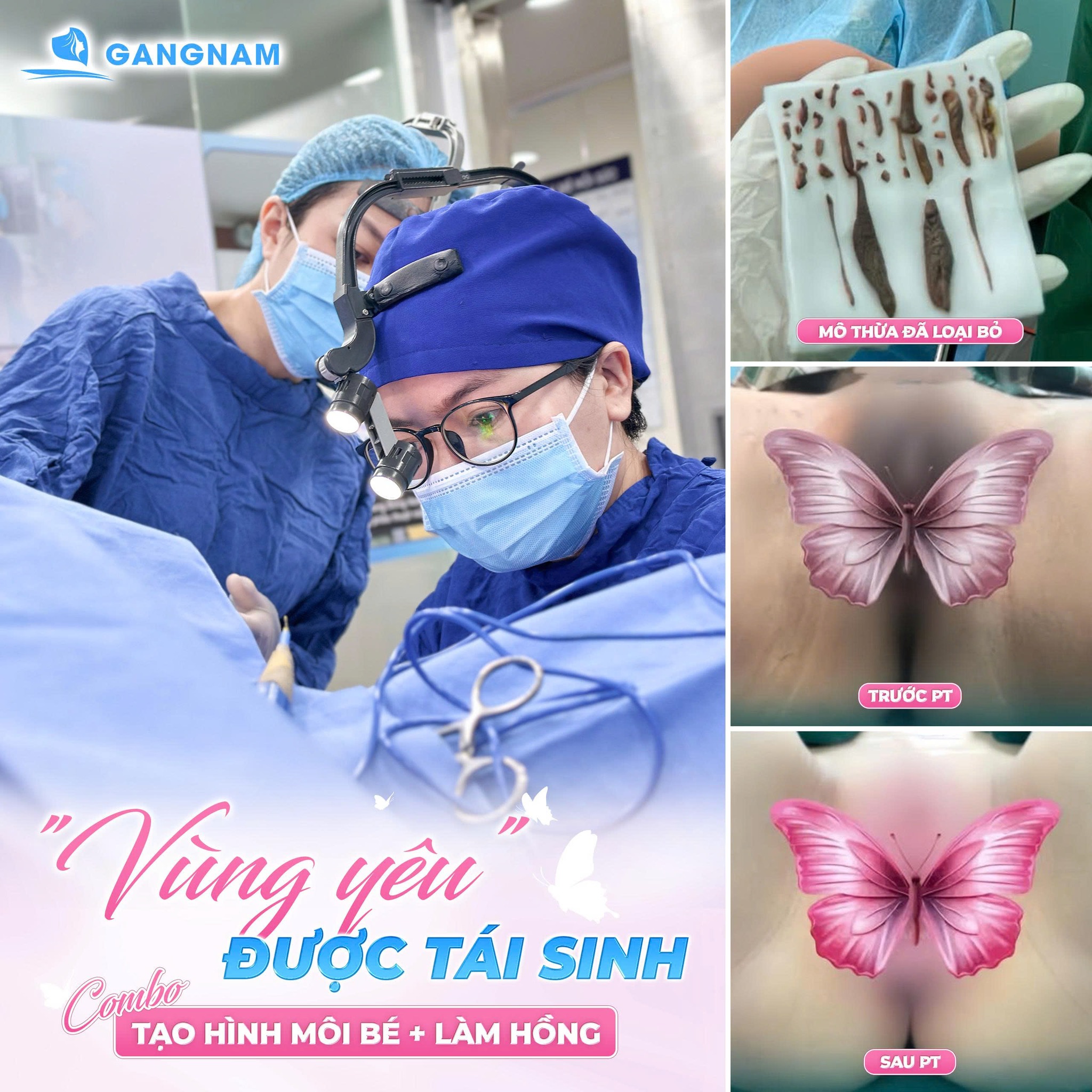 Thu Gọn Môi Cô Bé: Giải Pháp Thẩm Mỹ An Toàn, Tự Nhiên Và Cải Thiện 5 Đối tượng phù hợp và quy trình thực hiện thu gọn môi cô bé