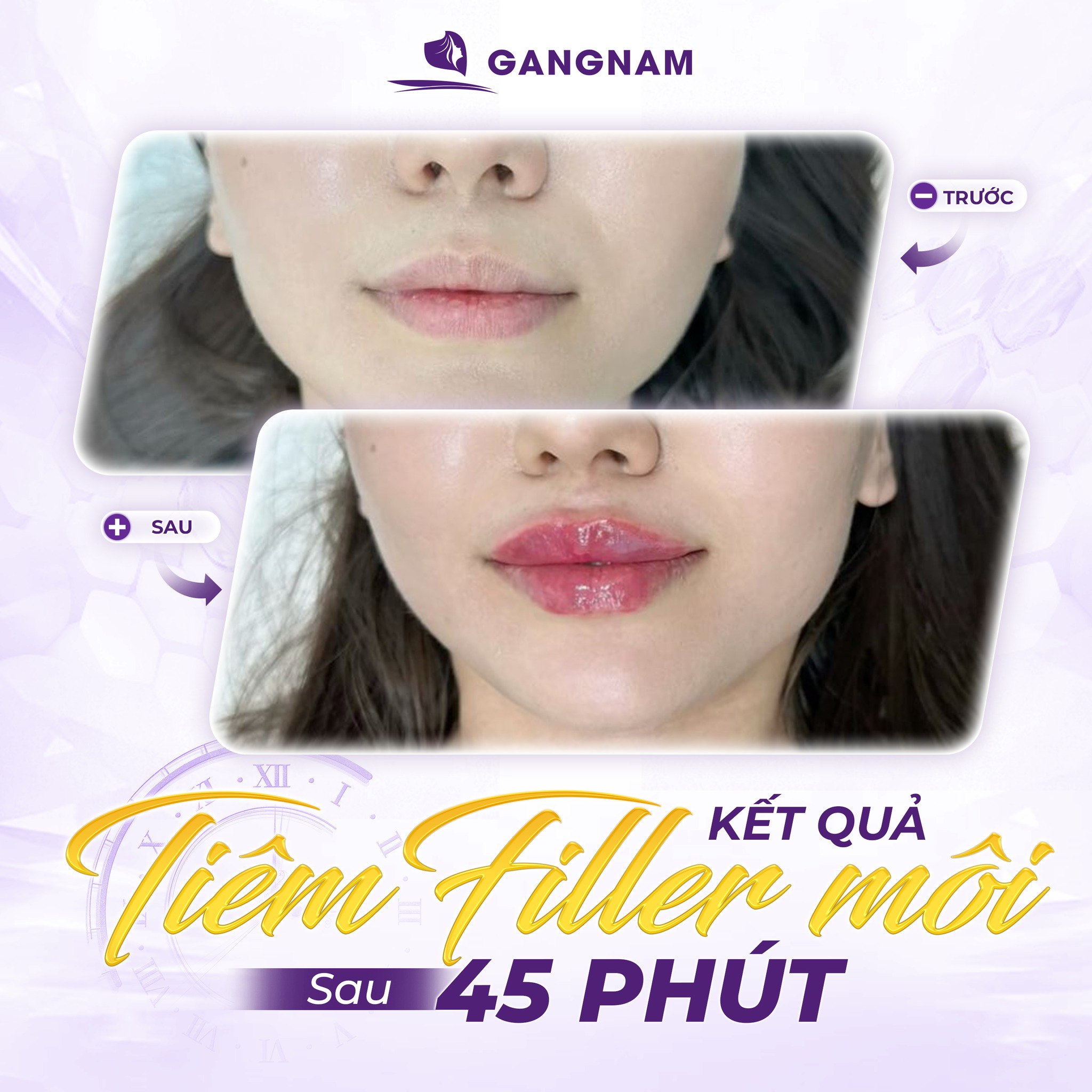 Tiêm filler môi căng dịu dàng – xu hướng làm đẹp môi tự nhiên 5 Tiêm filler môi căng dịu dàng có an toàn và phù hợp với ai