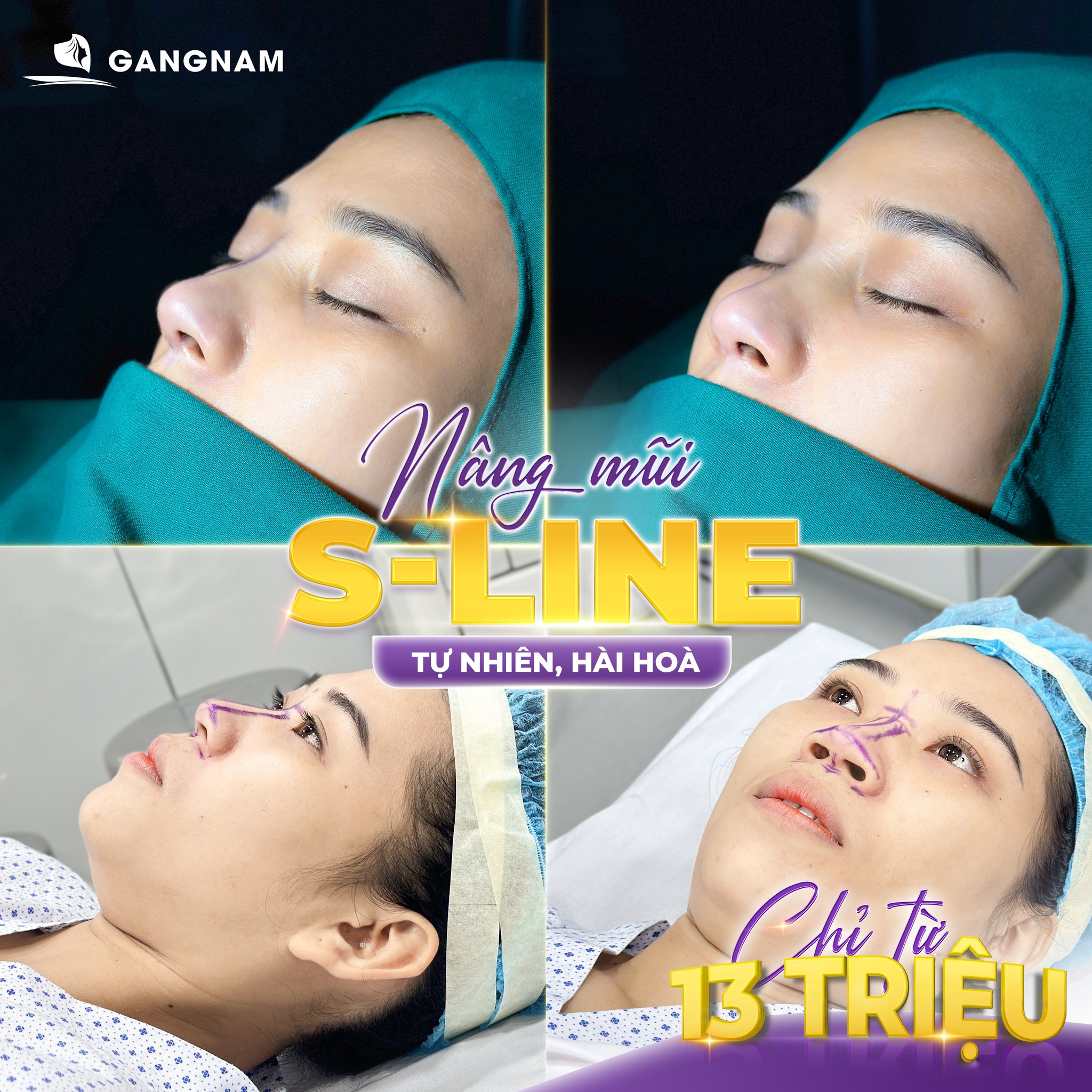 Nâng mũi S line tự nhiên – giải pháp tạo dáng mũi thanh thoát hài hòa 5 Quy trình thực hiện nâng mũi S line tự nhiên chuẩn y khoa