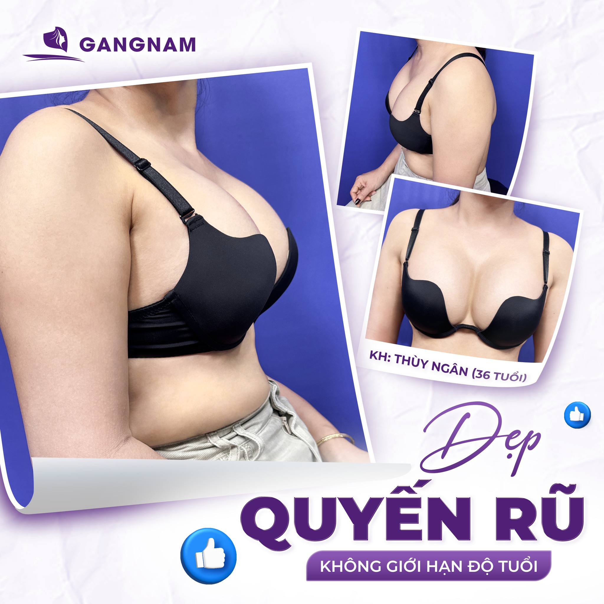 Tạo Dáng Ngực Giọt Nước: Giải Pháp Nâng Ngực Tự Nhiên, Hài Hòa 6 Tạo dáng ngực giọt nước