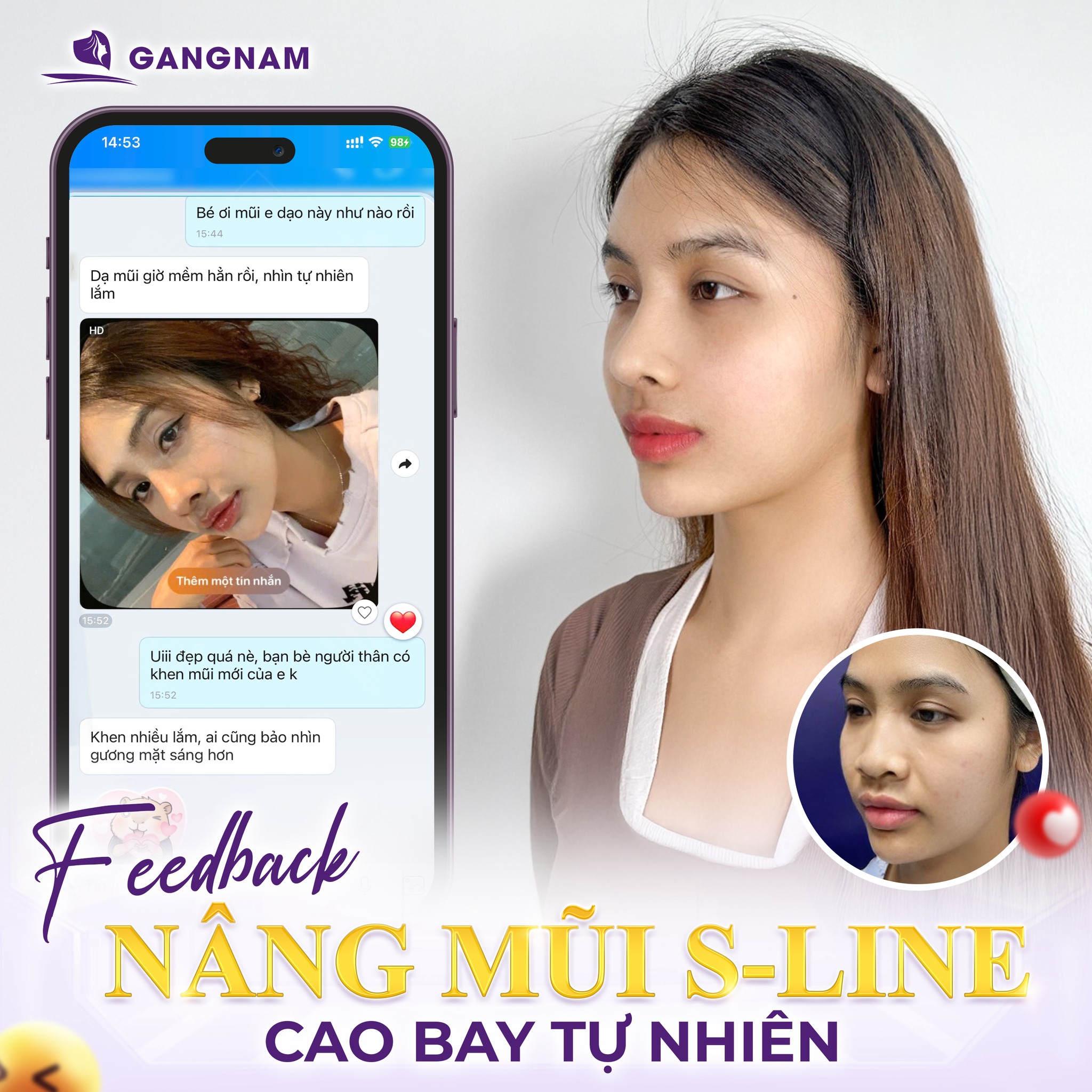 Nâng mũi cấu trúc dáng S-line – Giải pháp tạo hình mũi mềm mại, tự nhiên 5 Nâng mũi cấu trúc dáng S-line – Giải pháp tạo hình mũi mềm mại, tự nhiên 2