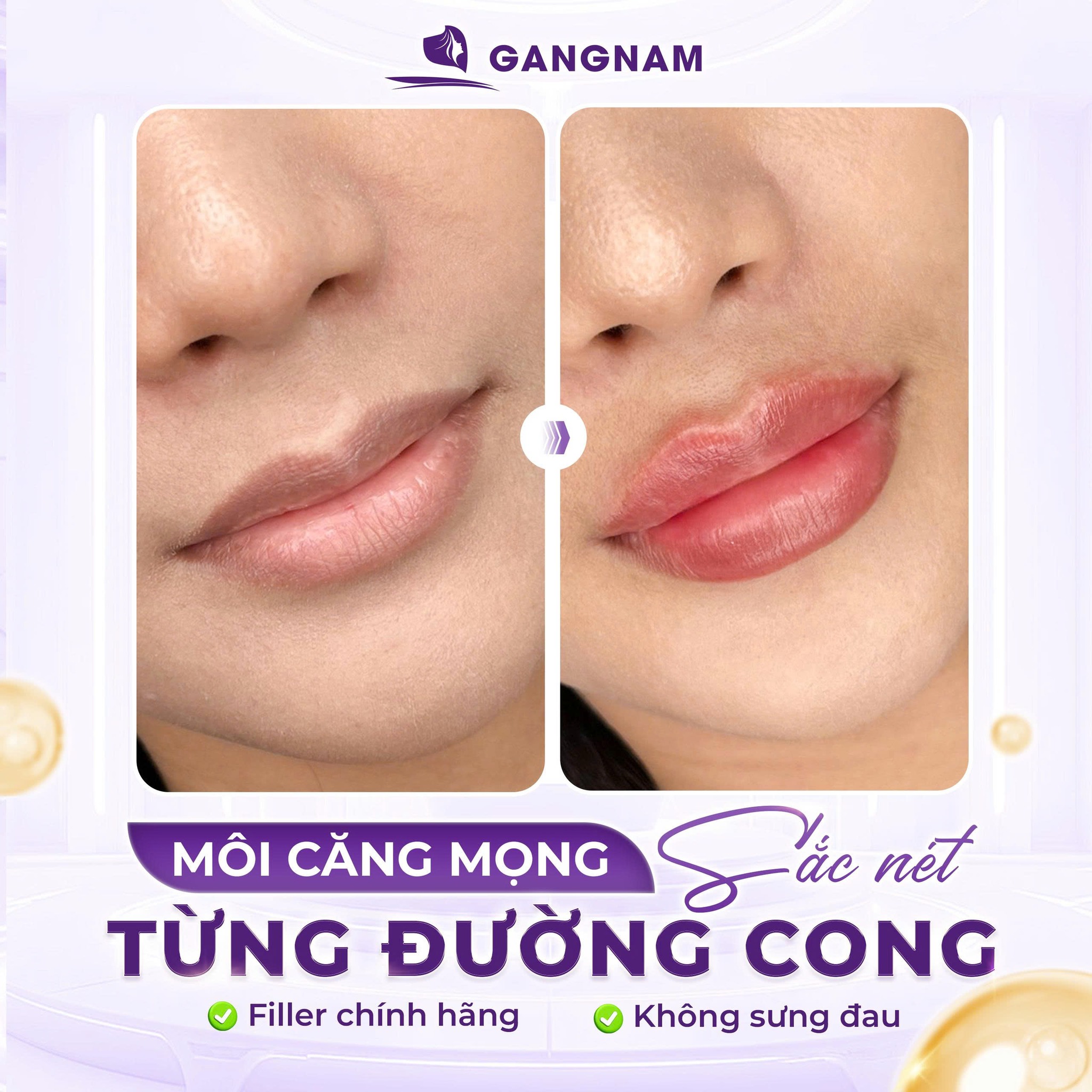 Tiêm môi filler: Giải pháp tạo dáng môi căng mọng tự nhiên, an toàn 6 Tiêm filler môi tại Thẩm mỹ Gangnam – Giải pháp làm đẹp an toàn, tự nhiên